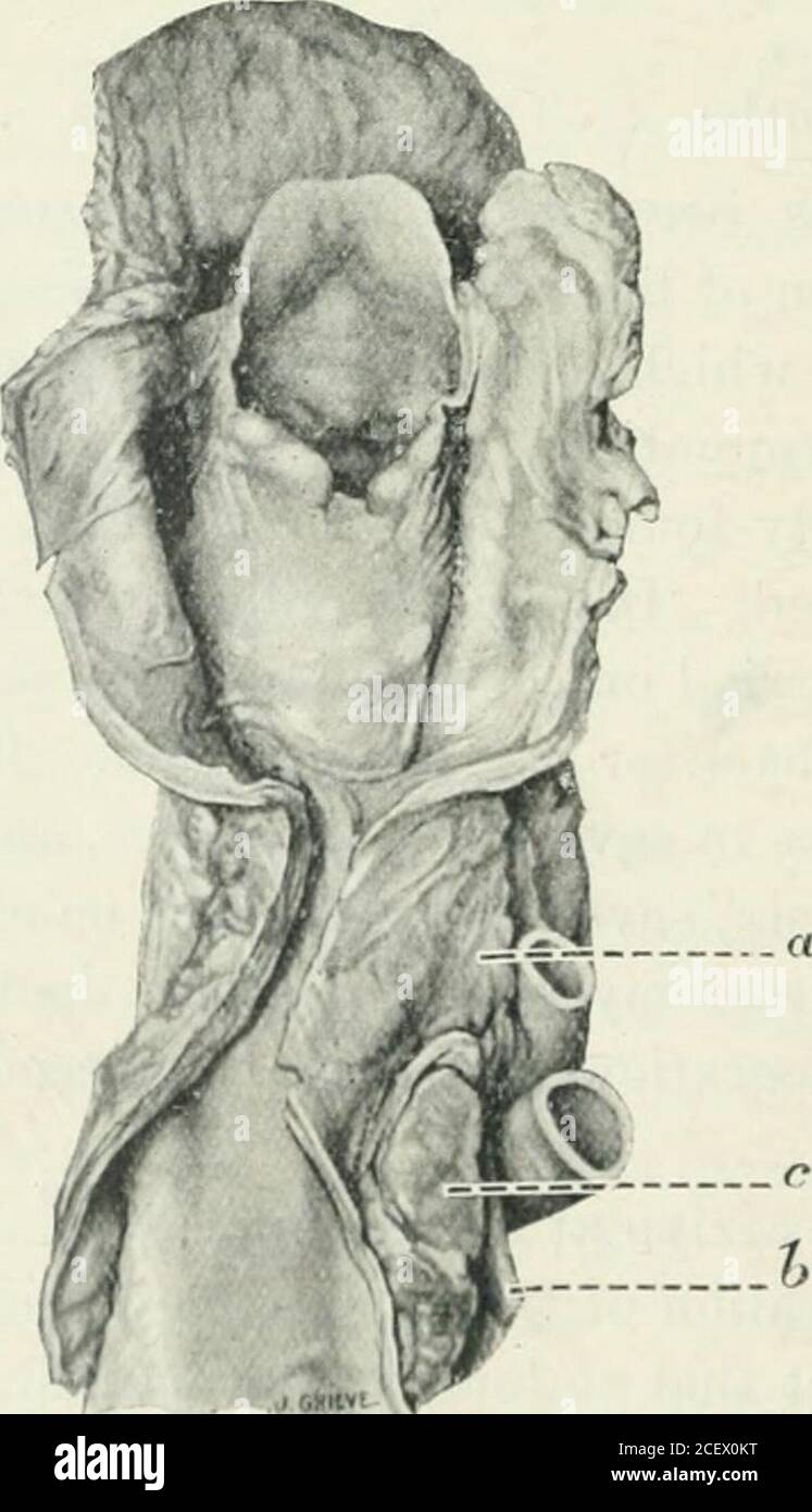 . Le Journal de la laryngologie et de l'otologie. Figure 1.—épitheliome squameux de l'oesophage et hypo-pharynx d'aAvoman, âgé de quarante-huit ans. Durée des symptômes, sept ans. Figure 2.—cpitlicoma squameux de l'extrémité supérieure de aSoi&gt;liagus d'une femme,tifty-cight vieilli. Durée des symptômes six mois, (a) maladie lyingextérieur de l'oesophage avec le nerf laiyngé droit récurrent qui y passe; (h) nerf laryngé droit récurrent; (r) glandes lymphatiques eilargées. 1913.J Rhiiologie et Otologie. 297 fontiné à l'oesophage, howev^er, des variations remarquables de sa & lt;la respiration sont rencontrées. Une exp Banque D'Images