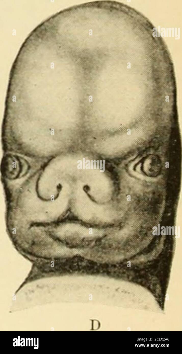 . Un livre de texte américain d'obstétrique. Pour les praticiens et les étudiants. Figure 87.—développement de la face de l'embryon humain (SIH): A, embryon d'environ vingt-neuf jours. La plaque nasodrontale se différenciant en processus globulares, vers laquelle s'étendent les processus maxillaires de la première arche viscérale. B, embryon d'environ trente-quatre jours: Les processus globulaire, latéral, frontal et maxillaire sont en apposition: L'ouverture primitive est maintenant mieux définie. C, embryon de la huitième semaine: Les limites immédiates de la bouche sont plus définies et les orifices nasaux sont partiellement formés, oreille externe a Banque D'Images