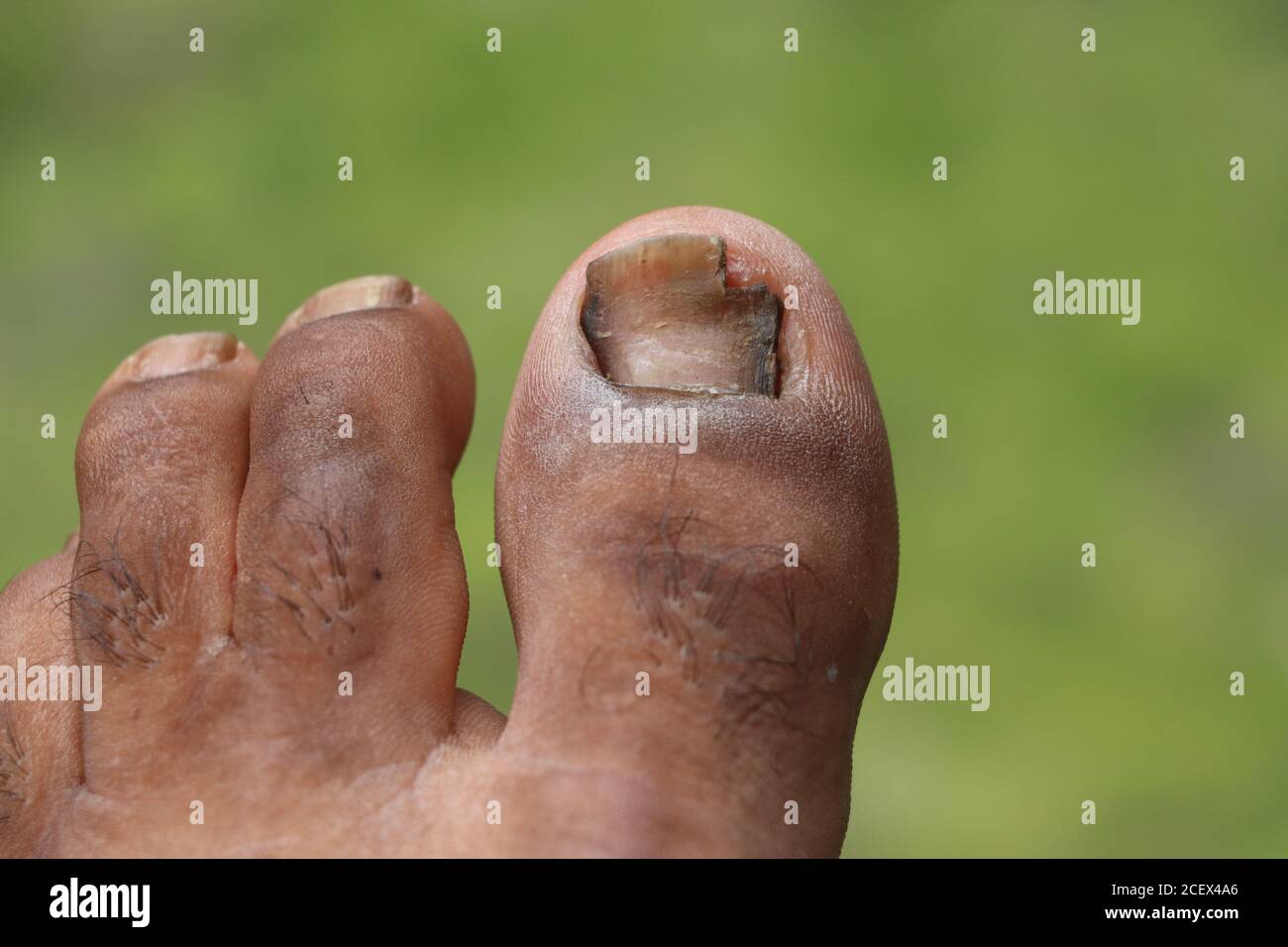 Ulcères du pied, figure dehors de l'ongle, champignon de la Toenail au pic de l'infection, Onychocryptose sur fond vert Banque D'Images