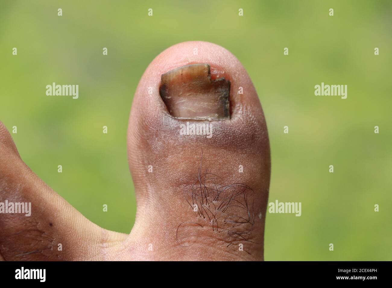 Figure dehors l'ongle, accident traumatisme de l'ongle, ulcères de pied, Onychocryptose sur fond vert Banque D'Images