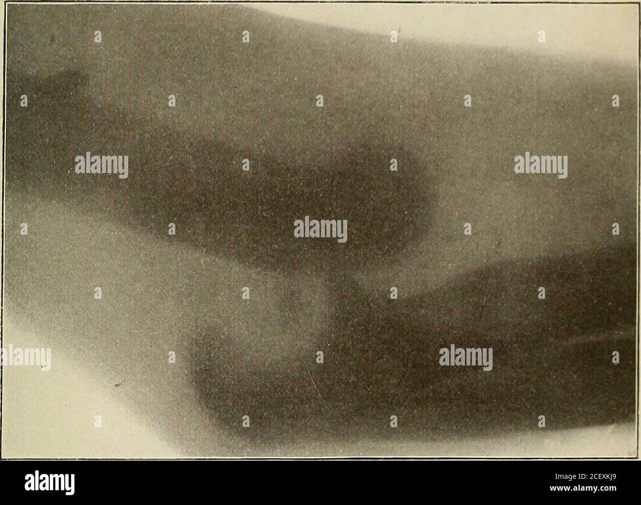 . Un traité pratique sur les fractures et les dislocations. Dislocation de l'ulnaalone en arrière, première forme. ISedillot.) PLAQUE XLVII.. Luxation arrière du coude. DISLOCATIONS DE L'ULNA SEUL. CTR, légèrement incliné vers le côté ulnaire ; le froid du coude était quelque-ce qui a été soulevé par la trochlea en saillie ; l'olécrâne était très proéminent derrière, mais à peine élevé au-dessus de son niveau normal ; le coude était sensiblement plus épais, mais pas plus large ; le cordon du rayon était en si-;place ; la pronation et la supination étaient légèrement limitées, le mouvement de flexion de la bul theleast était très douloureux. Réduction Banque D'Images