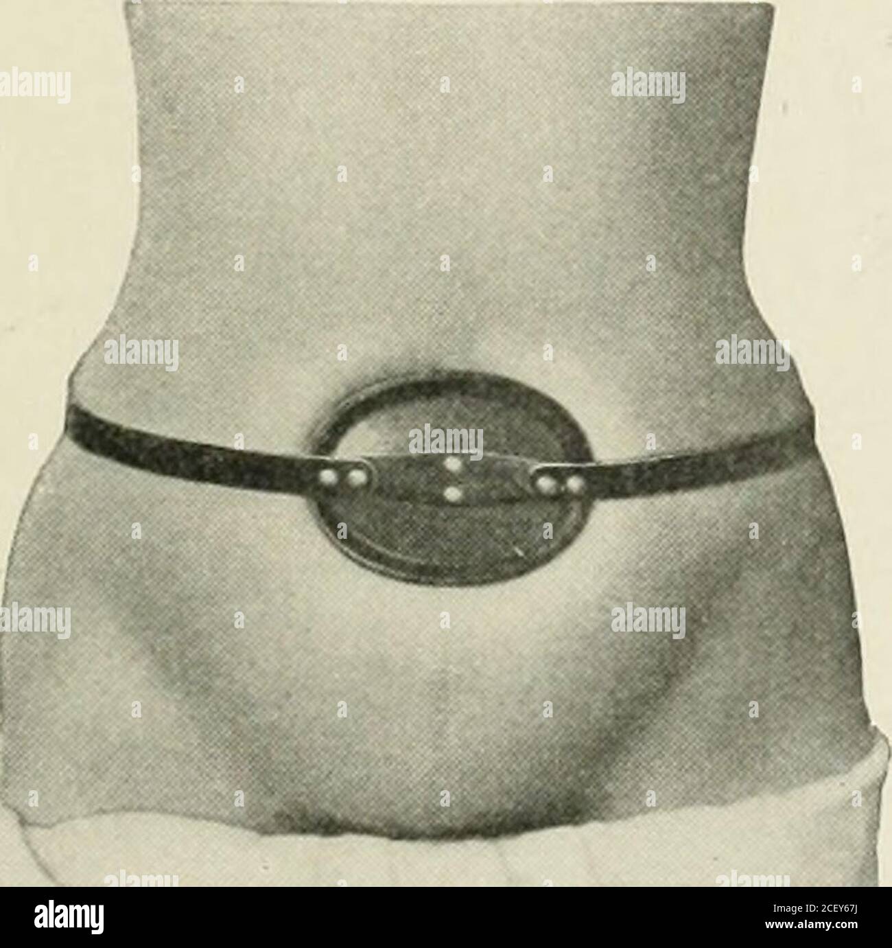 Hernie Abdominale Son Diagnostic Et Son Traitement 13 Coussinet En Caoutchouc Extra Dur Ressort Elliplic Et Main A Utiliser En Combinaison Avec La Ceinture Abdominale 14 Charpente Ombilicale A Ressort Hernie Abdominale Son Diagnostic Et Son Traitement 13 Coussinet En Caoutchouc Extra Dur Ressort Elliplic Et Main A Utiliser En Combinaison Avec La Ceinture Abdominale 14 Charpente Ombilicale A Ressort