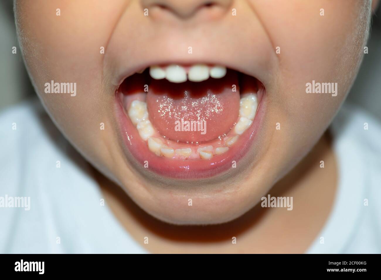 Un petit garçon à bouche ouverte montrant des dents de lait et des dents en croissance constante. Banque D'Images