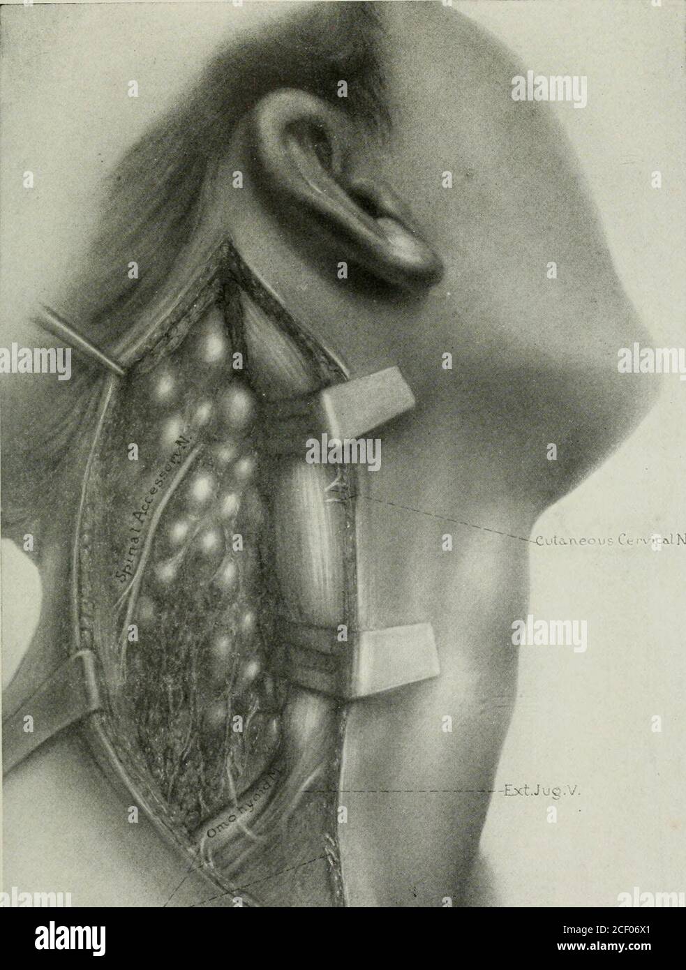 Supra clavicular incision Banque de photographies et d’images à haute résolution Alamy