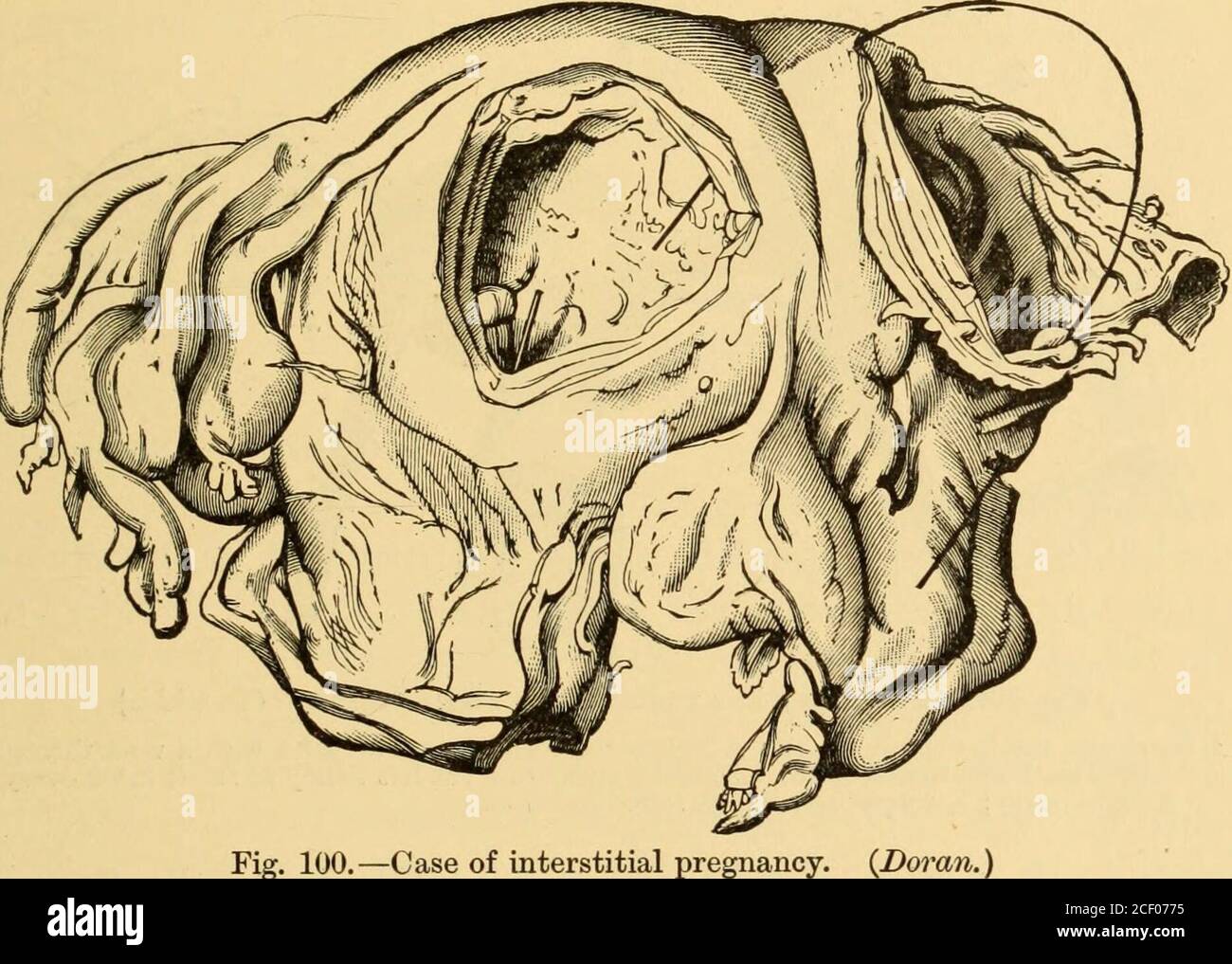 . Maladies des femmes. Un guide clinique de leur diagnostic et de leur traitement. L'ure de l'utérus pendant la grossesse, avant le travail, est rare. Quelque temps la rupture a lieu parce que la grossesse est interstitielle ; c'est-à-dire, dans la partie du tube de Fallope qui traverse l'Avail utérin (Figs. 98, 99, 100). Mais la rupture de l'utérus dans la grossesse apparemment normale peut avoir lieu.Robert Barnes* cite cinq cas de cela. Trois de ces éléments ne sont pas disponibles dans les volumes auxquels Barnes fait référence. Dans One t Obstetric Operations. f Mitchell, Obst. TRANS., 1870. GRANDE HÉMORRAGIE INTERNE. 299 le patient était en l Banque D'Images
