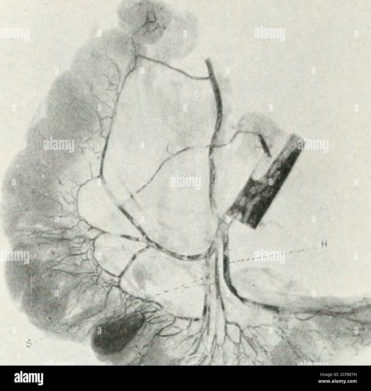 . Annales de chirurgie. A, point critique; B, trop faible pour fournir tout le système rectal; S, sigmoïde; H, sup. Hem.artère;Z-, loopanastomosing withsup. Hem. Artère sous la bifurcation. Fi.-,.. S, artères sigmoïdales ; H, artère sup. Ourlet ; L, aucune boucle bien développée présente. Figure 3. Banque D'Images . Annales de chirurgie. A, point critique; B, trop faible pour fournir tout le système rectal; S, sigmoïde; H, sup. Hem.artère;Z-, loopanastomosing withsup. Hem. Artère sous la bifurcation. Fi.-,.. S, artères sigmoïdales ; H, artère sup. Ourlet ; L, aucune boucle bien développée présente. Figure 3. Banque D'Images