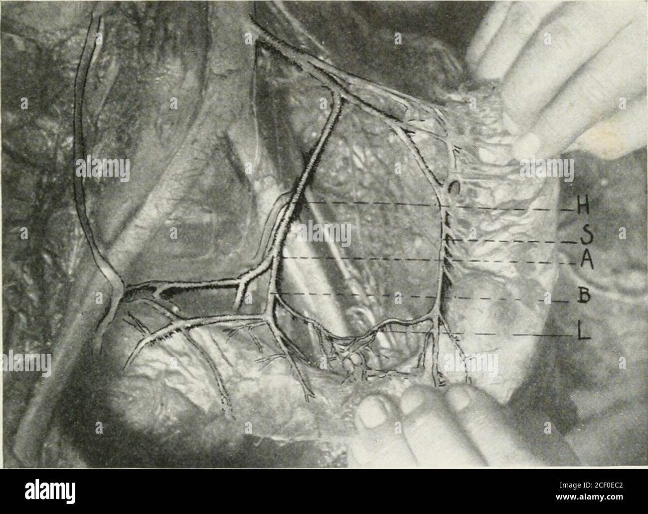 . Annales de chirurgie. Envoyé dans deux cas (Fig. 2).dans ces cas, la ligature de l'artéryat hemorrhoidal supérieur à n'importe quel point aurait abouti à la gangrène, comme la vasculararanastomose dans la paroi de l'intestin ne donnerait pas assez de sang. Après résection du rectum pour un lyingcarcinome élevé dans de tels cas, il serait plus sûr de dessiner l'extrémité proxi-mal du rectum ou sigmoïde à travers le mur abdominal et de former un iliaque anus. La boucle variait en calibre artère froman aussi grande que les vaisseaux qu'elle reliait à un simple vaisseau de type fil en un seul cas. La boucle a été trouvée sur une average1.5 C. Banque D'Images . Annales de chirurgie. Envoyé dans deux cas (Fig. 2).dans ces cas, la ligature de l'artéryat hemorrhoidal supérieur à n'importe quel point aurait abouti à la gangrène, comme la vasculararanastomose dans la paroi de l'intestin ne donnerait pas assez de sang. Après résection du rectum pour un lyingcarcinome élevé dans de tels cas, il serait plus sûr de dessiner l'extrémité proxi-mal du rectum ou sigmoïde à travers le mur abdominal et de former un iliaque anus. La boucle variait en calibre artère froman aussi grande que les vaisseaux qu'elle reliait à un simple vaisseau de type fil en un seul cas. La boucle a été trouvée sur une average1.5 C. Banque D'Images