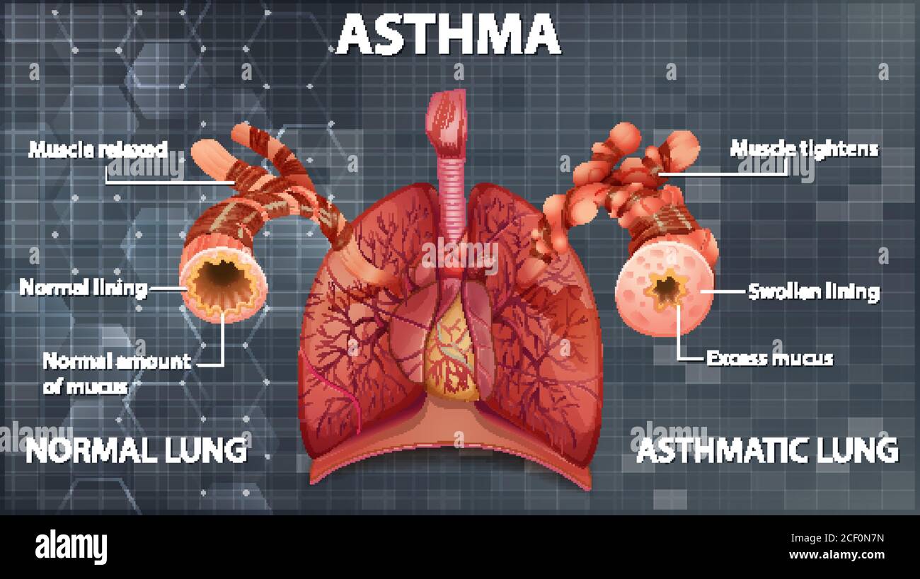 Comparaison des poumons sains et des poumons asthmatiques Illustration de Vecteur