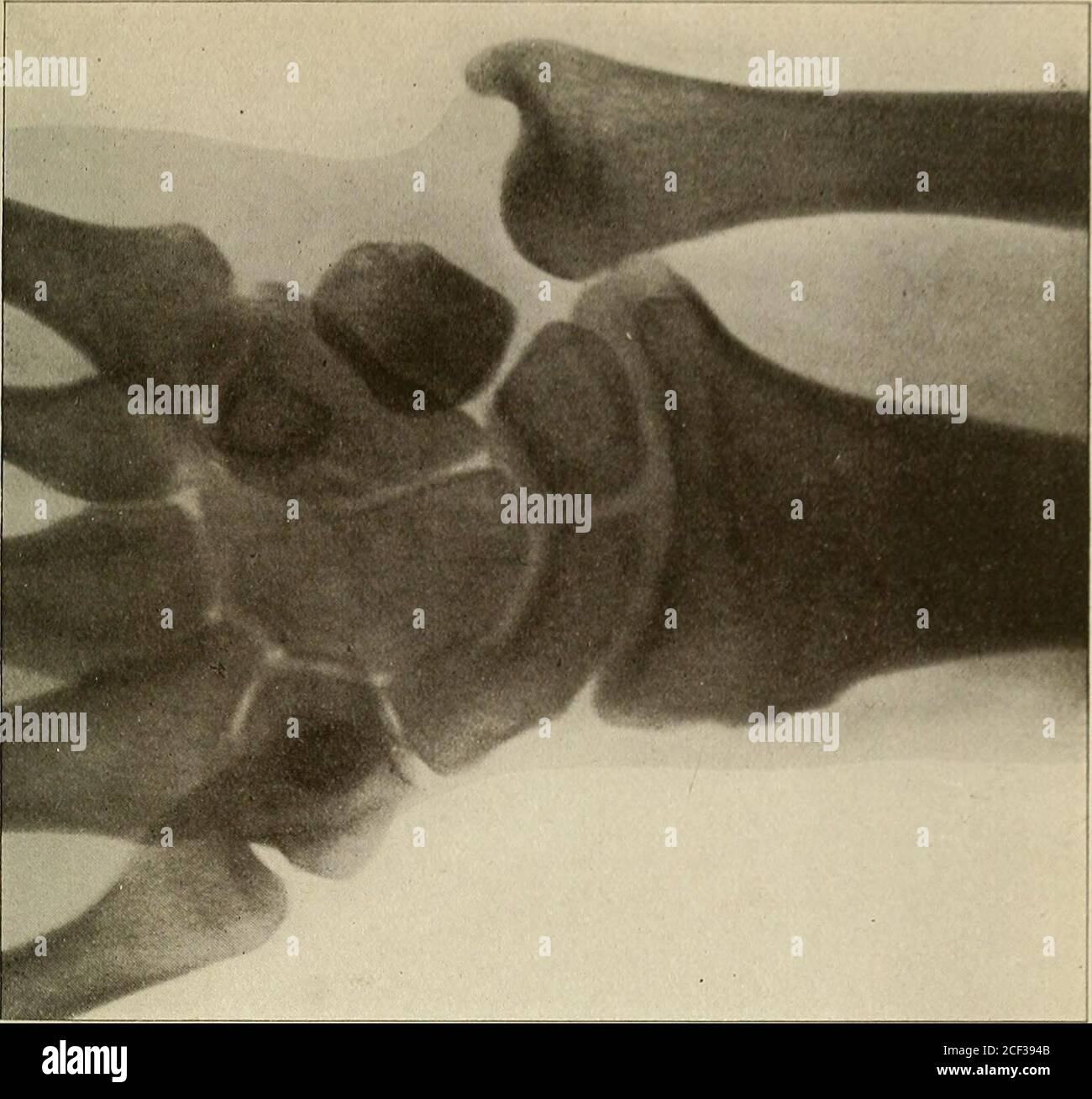 Fractures des plaques de croissance Banque de photographies et d’images à haute résolution Alamy