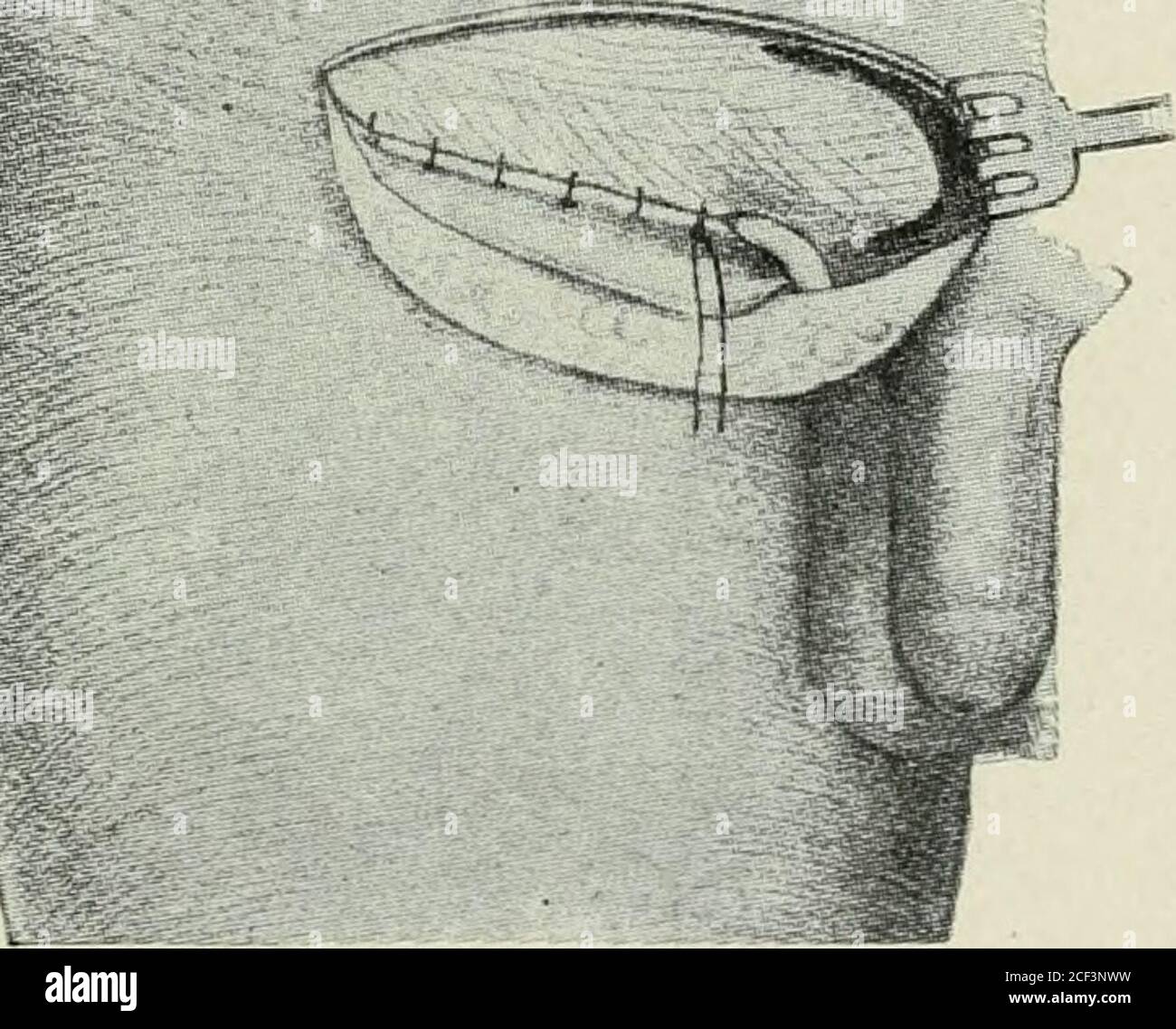 . Hernie abdominale : son diagnostic et son traitement. Les muscles obliques externes et internes.muscle transverse et fascia, rue puis tous cousus au ligament des parties de pou dans tout le canal à près de l'anneau externe, comme illustré sur la fig. 119. . le lambeau est alors fait à partir des deux tiers extérieurs de la gaine antérieure du rectus comme indiqué dans la coupe. et le cordon est transféré de l'anneau externe à l'angle supérieur de cette incision. Les fibres du muscle rectus sont disséquées et l'extrémité du rabat est cousue en dessous et le cordon comme illustré sur la fig. 120. Poule les sutures sont liées le C CHIRURGICAL Banque D'Images