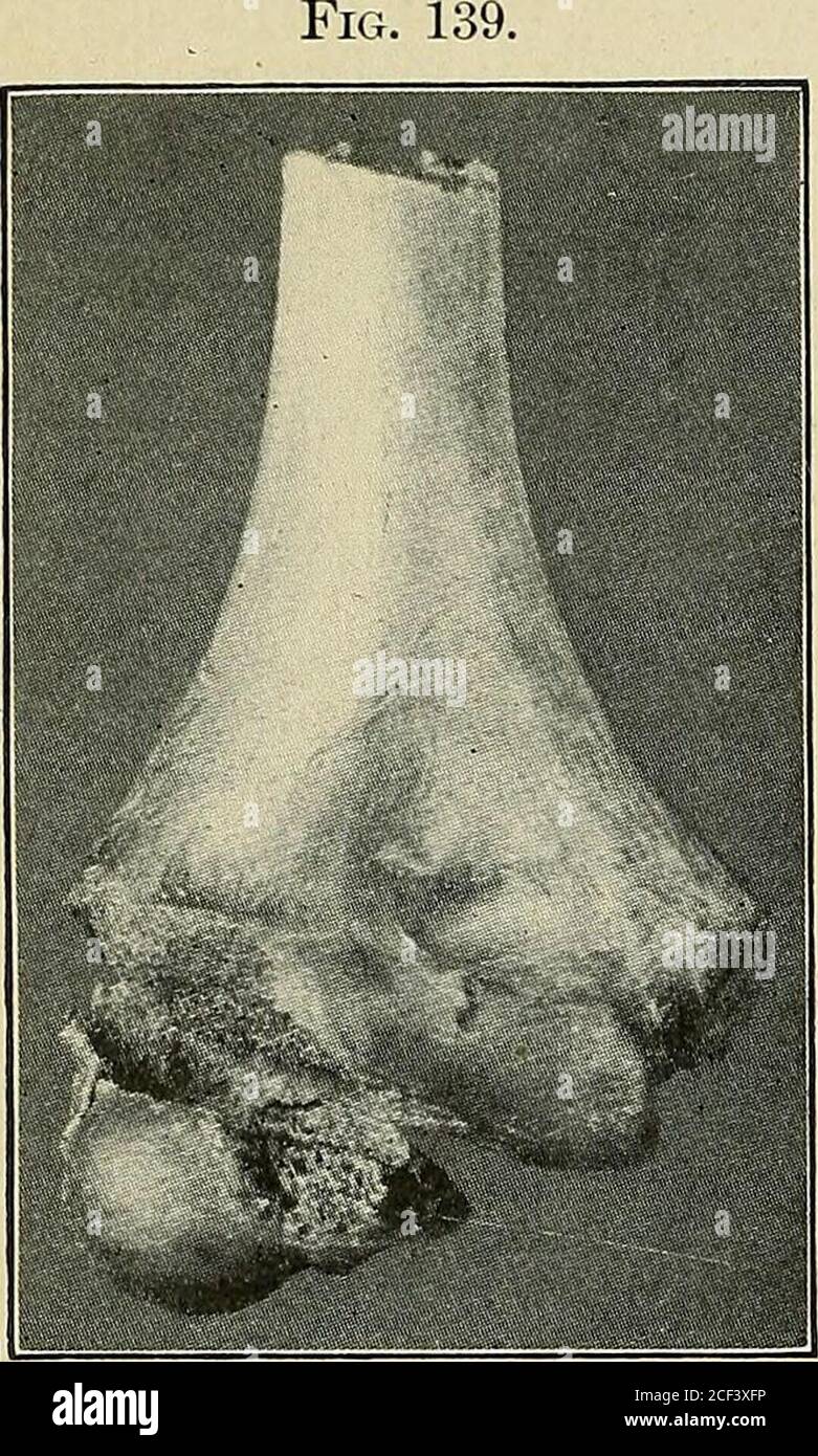 . Un traité pratique sur les fractures et les dislocations. Lignes de fracture de l'externalcondyle. 254 FRACTURES.. Capitellum dans une direction arrière ou arrière et vers le haut, dans la seconde à travers l'olecranon vers le haut et vers l'extérieur contre la pente externe de la trochlea, et dans la troisième itacts par l'avulsion par le ligament externe et les muscles attachedau coudyle. Je l'ai trouvé facile de produire la fracture par l'adduction de l'avant-bras étendu dans les corps des jeunes, ou par un coup sur la paume avec le coude fléchi à un angle droit (Fig. 122).dans un ou deux cas, j'ai pensé à la lecause wa Banque D'Images