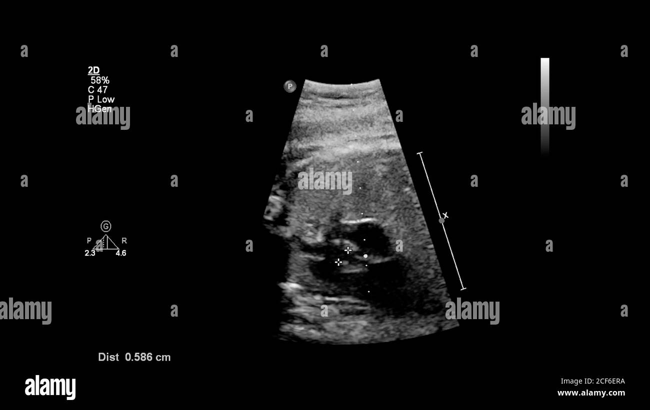 Ecran d'échographie avec échocardiographie fœtale. Banque D'Images