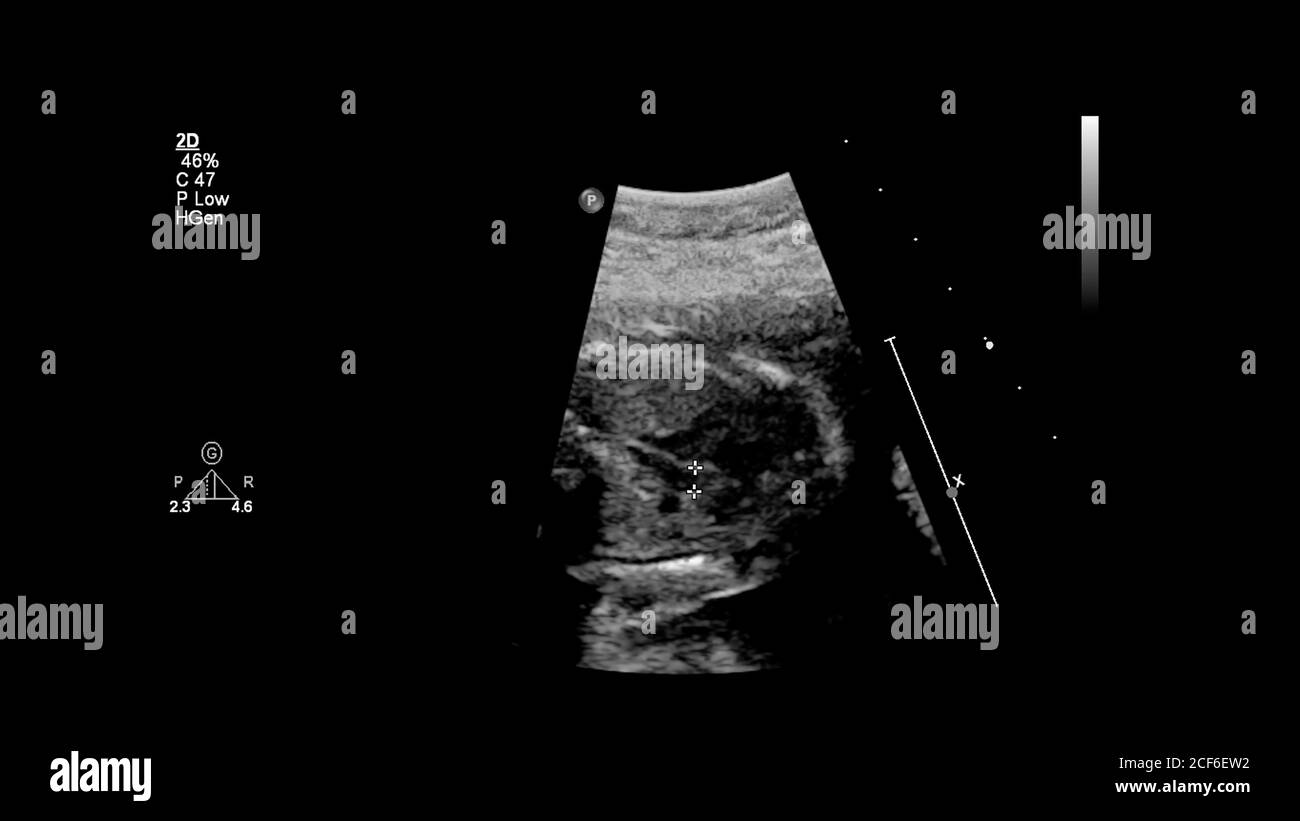 Ecran d'échographie avec échocardiographie fœtale. Banque D'Images