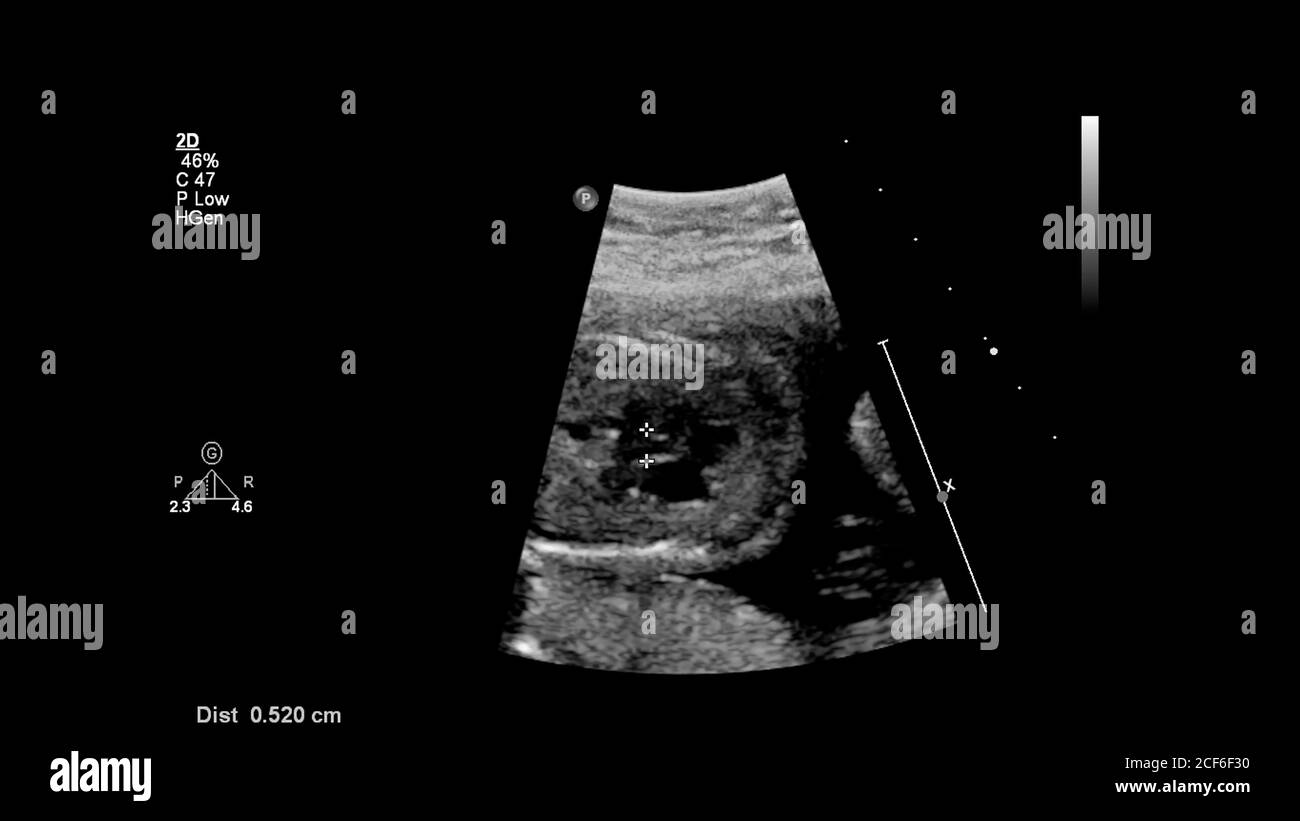 Ecran d'échographie avec échocardiographie fœtale. Banque D'Images