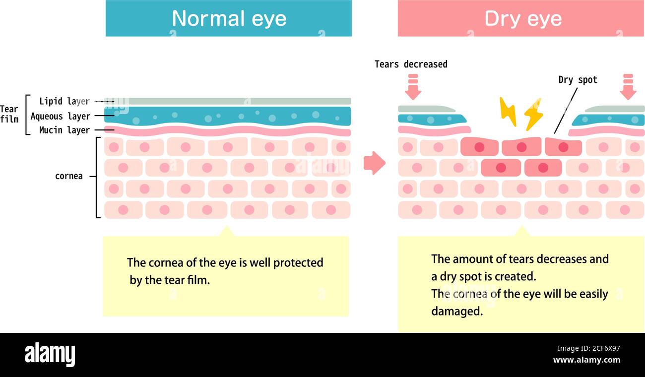 Illustration de comparaison entre l'œil normal et l'œil sec. Coupe transversale de la surface de l'œil. Illustration de Vecteur