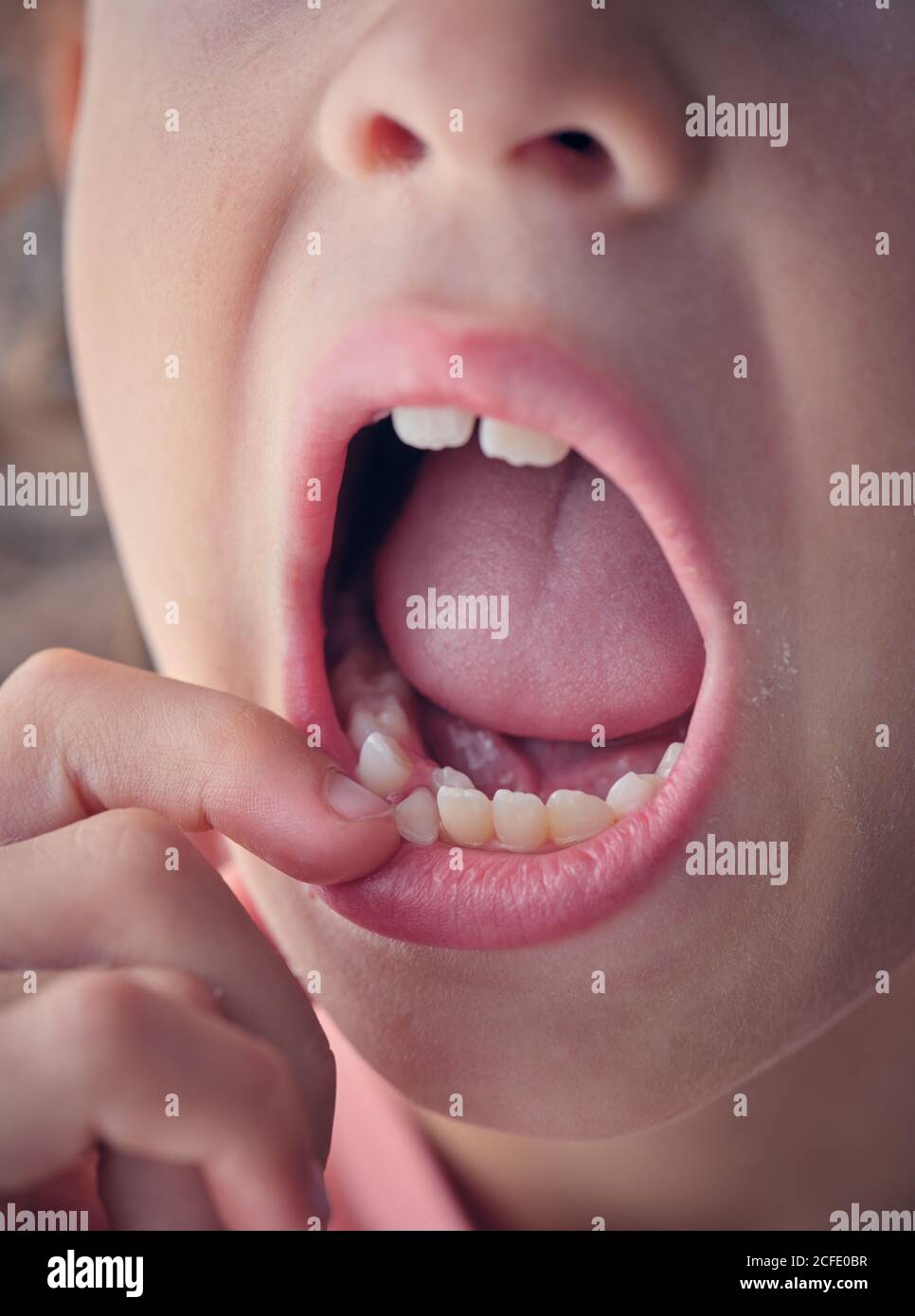Dent de bébé instable dans la bouche large ouverte de l'enfant anonyme tirer la lèvre vers le bas pour montrer la dent Banque D'Images