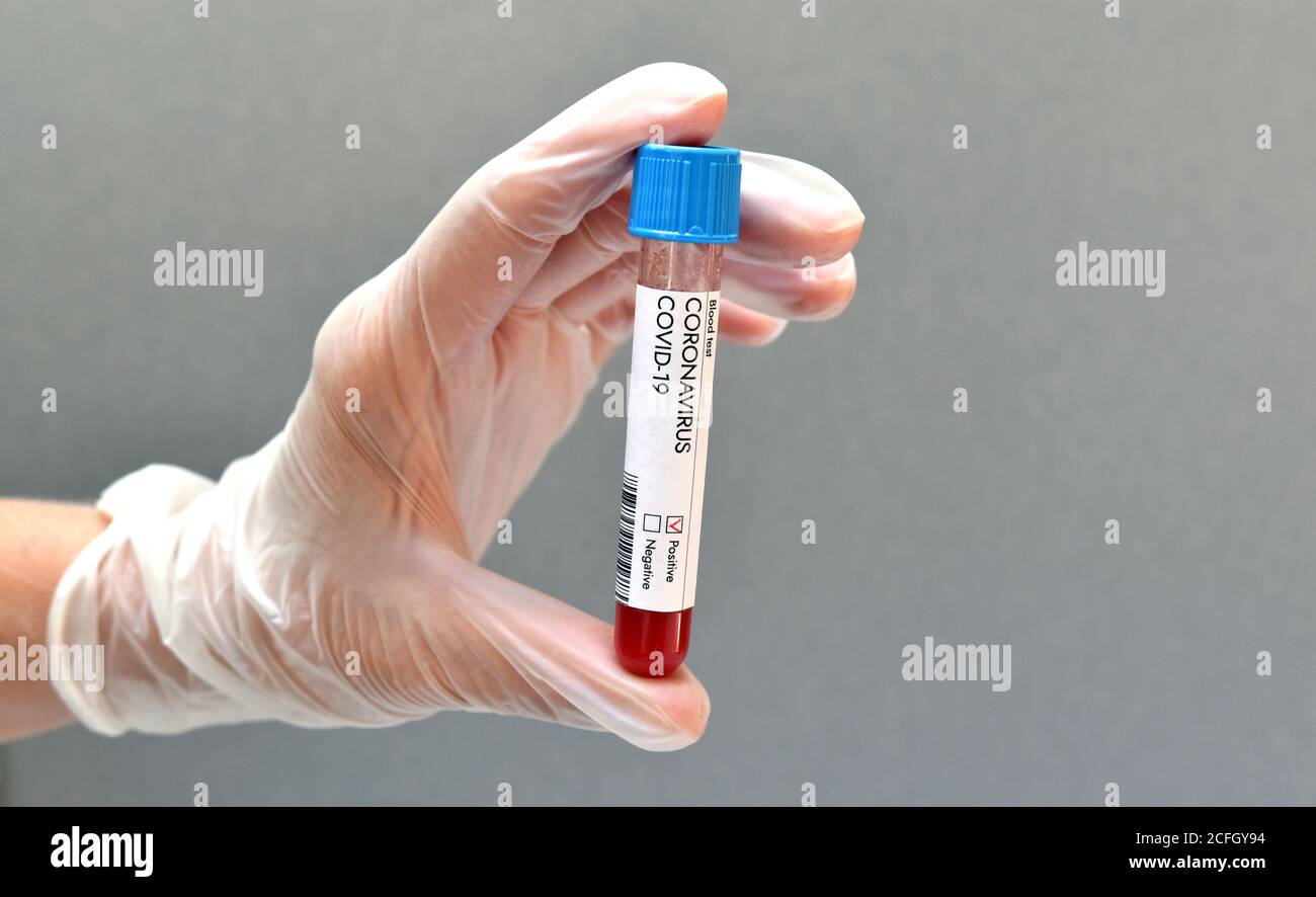 Test du coronavirus résultat positif de l'échantillon de sang sur fond blanc. Vaccin contre le coronavirus. Banque D'Images