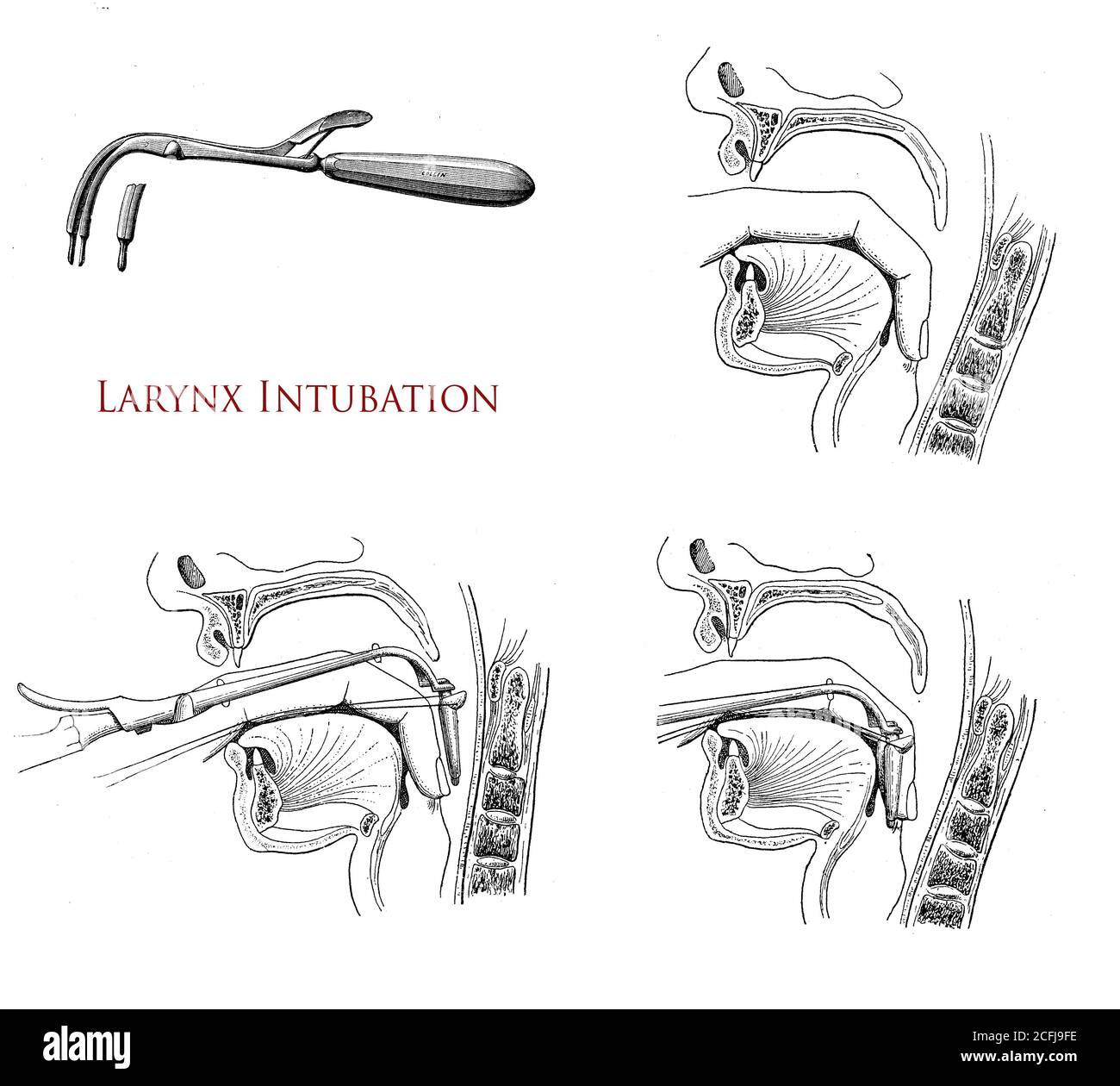 Soins de santé et médecine : intubation du larynx, trois dessins expliquant comment effectuer l'opération d'urgence Banque D'Images