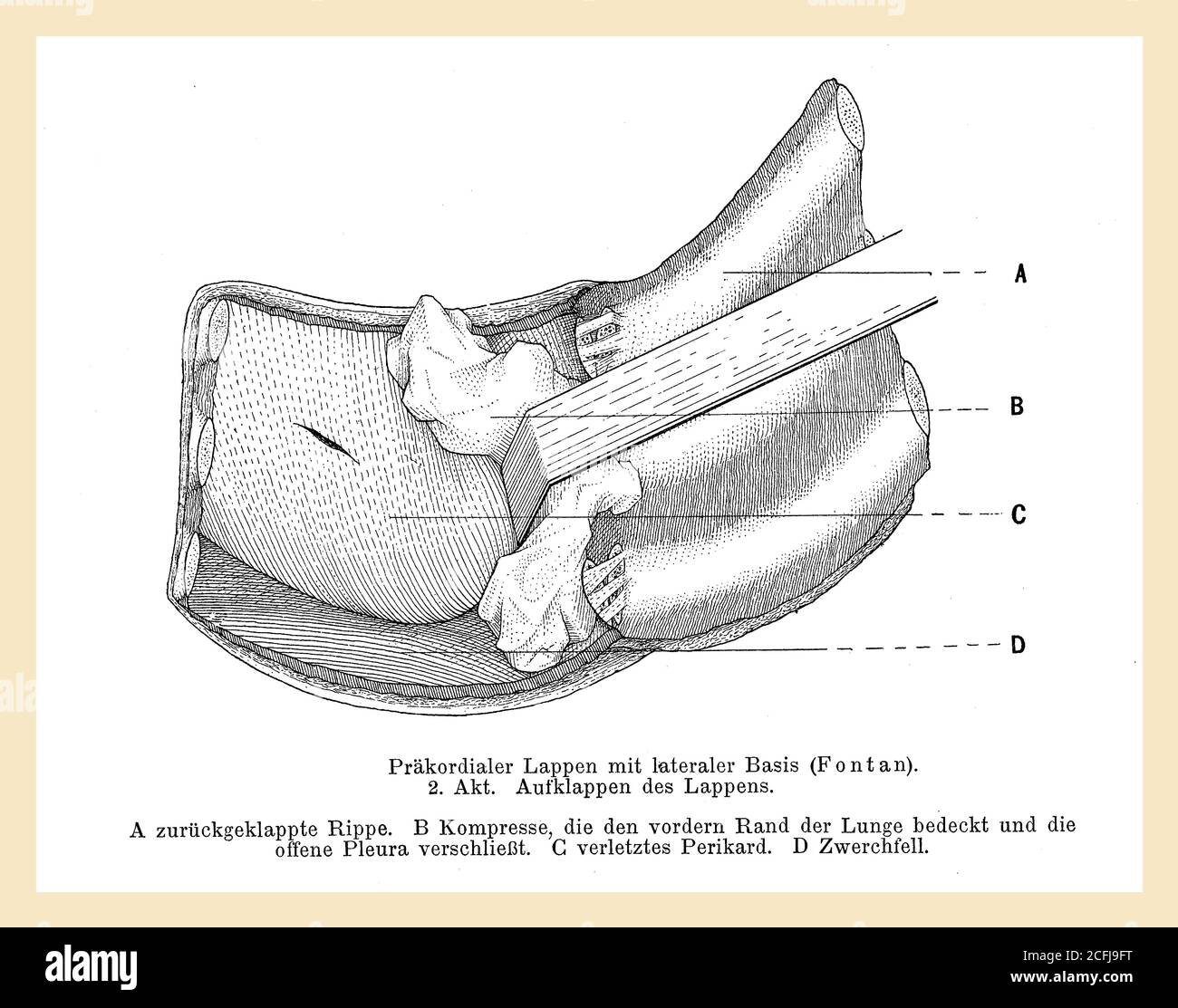 Santé et médecine: Dessin expliquant comment déplier un lobe précordial dans une opération chirurgicale avec une description allemande Banque D'Images