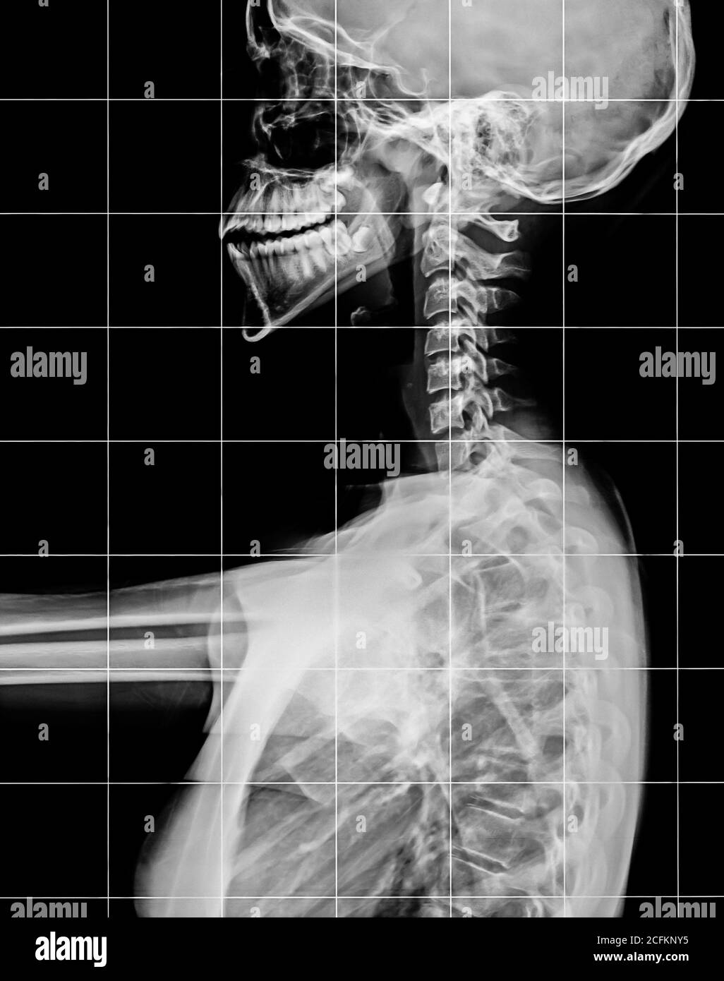 Rayons X de la colonne vertébrale et de la tête du crâne. Banque D'Images