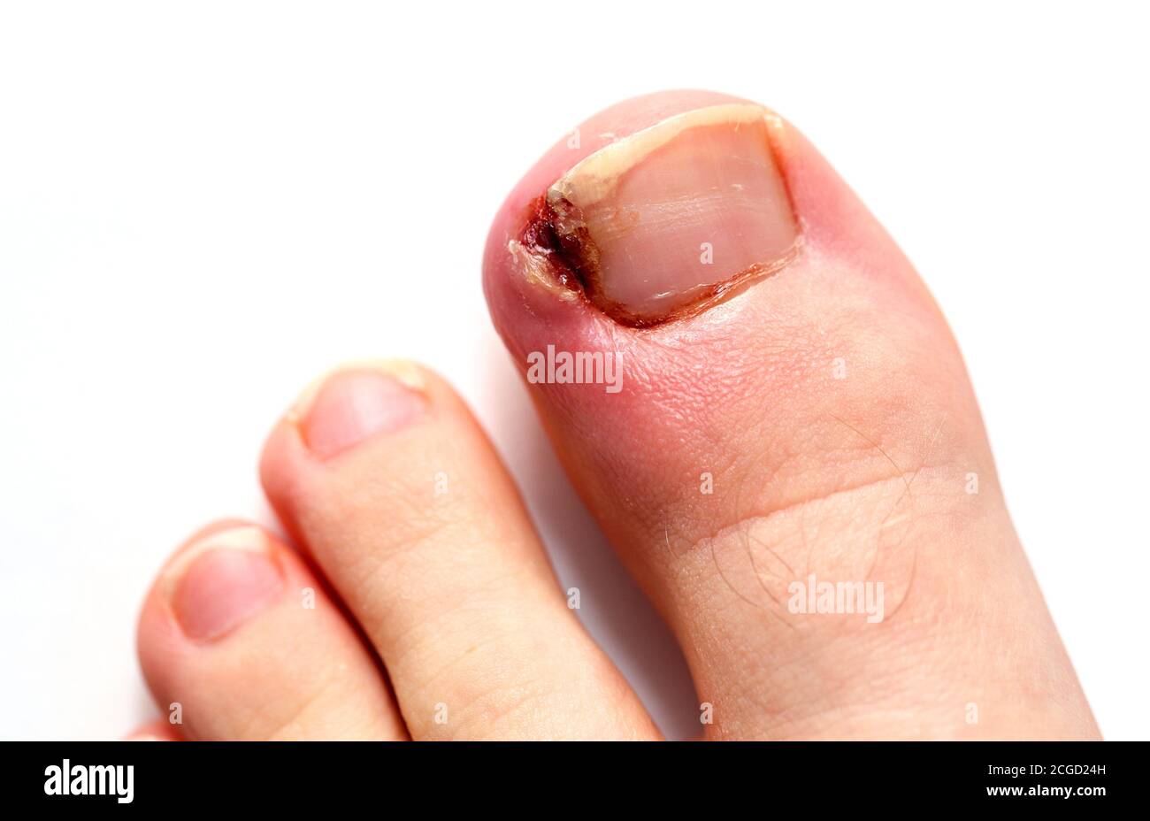 Ongle D Orteil Banque D Image Et Photos Alamy