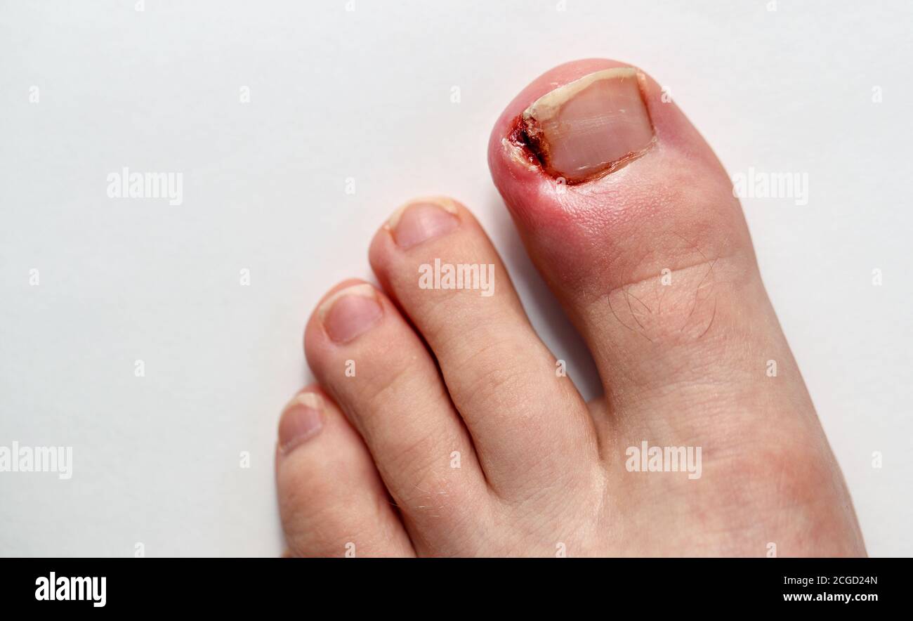 Ongle du pied incarné infecté sur le gros orteil d'un adolescent sur fond blanc. Banque D'Images