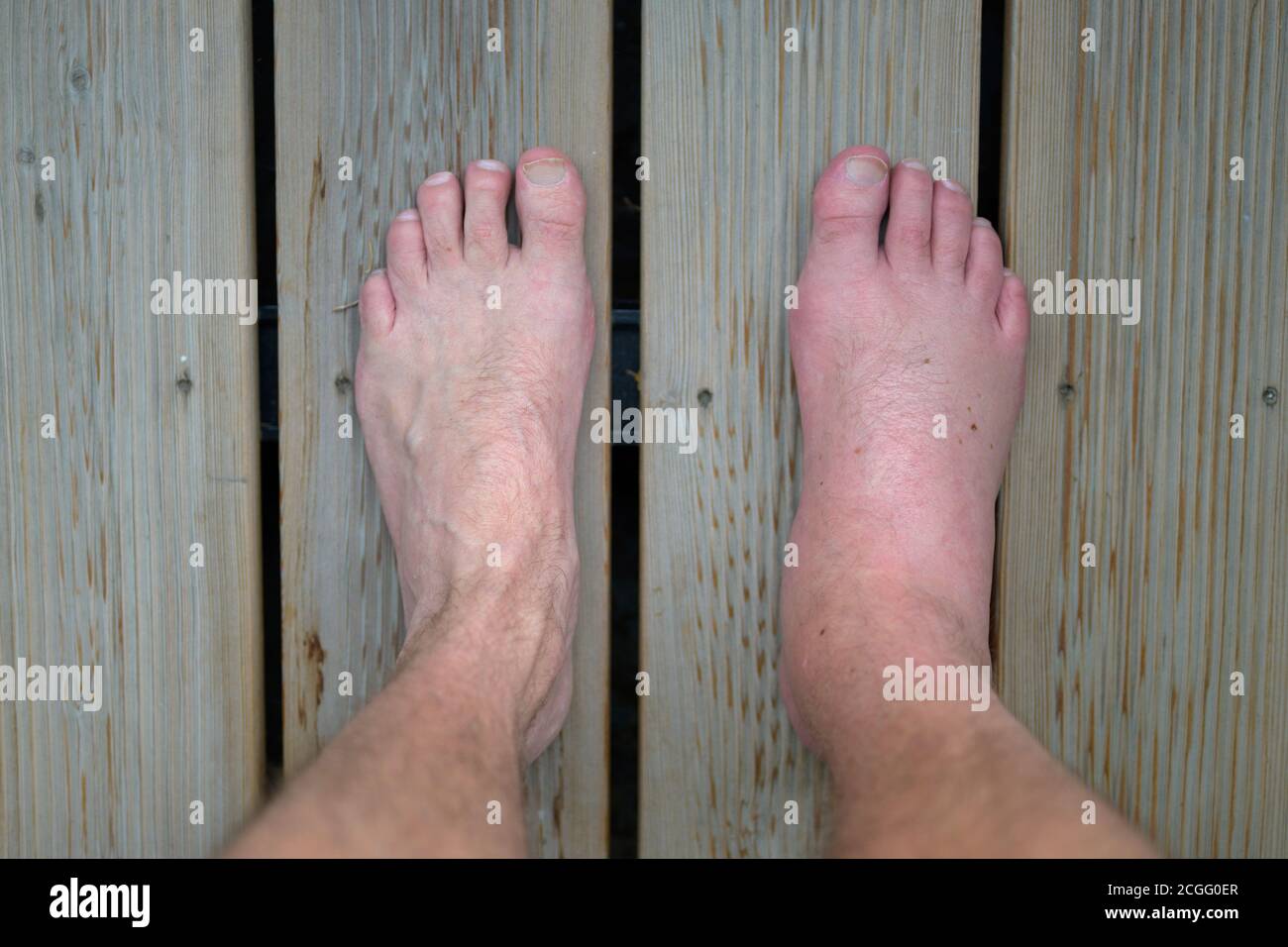 Gonflement du pied d'un homme souffrant d'une réaction allergique à la piqûre ou la piqûre d'un insecte regardant vers le bas à ses pieds sur un plancher en bois avec le he Banque D'Images