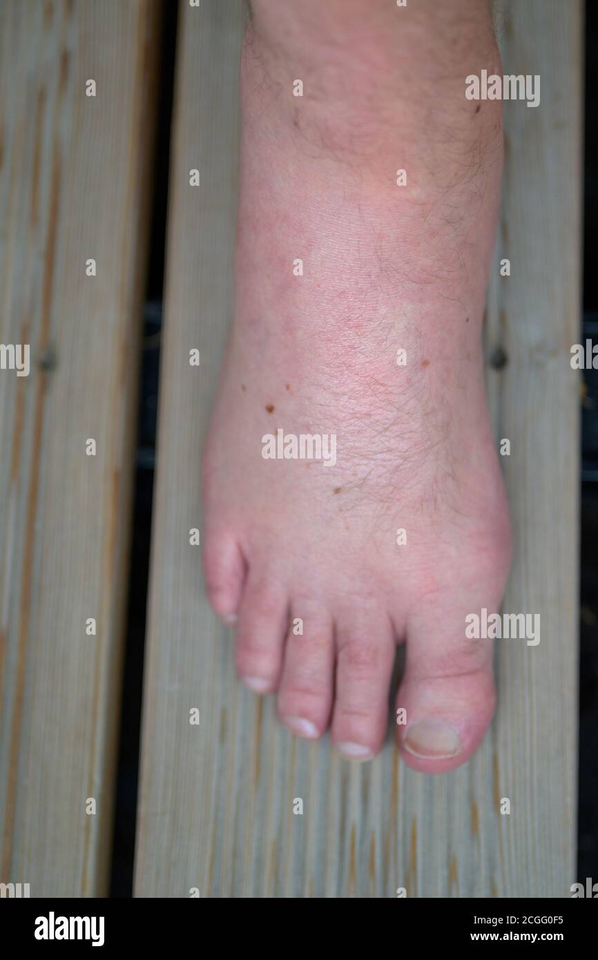 Gonflement du pied enflammé d'un homme à partir d'une piqûre d'insecte ou morsure après une réaction allergique en regardant vers le bas par le dessus sur un plancher en bois dans un système de santé ou moi Banque D'Images