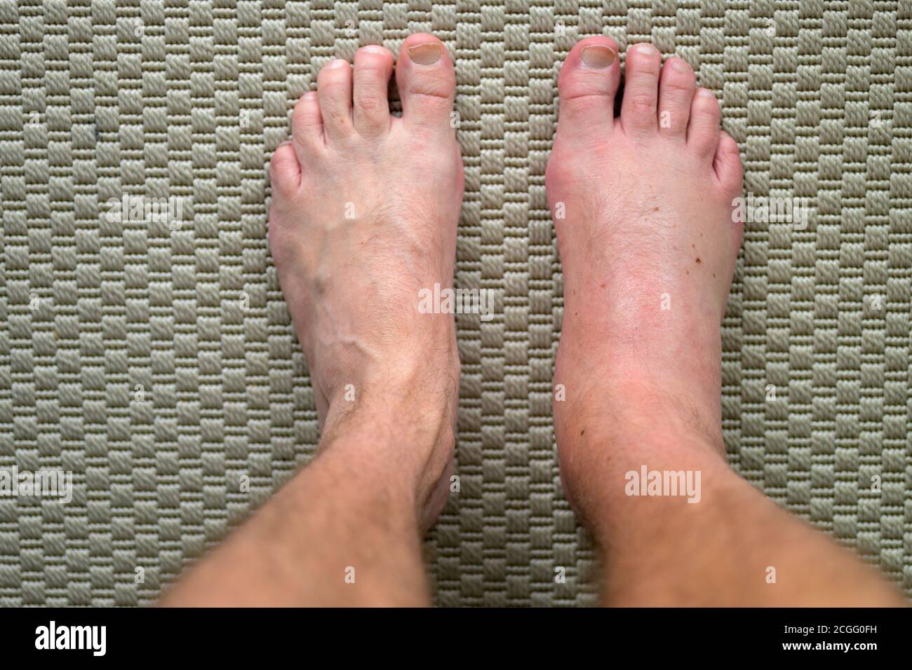 Homme avec un pied mal gonflé et enflammé d'une allergie réaction après une piqûre ou une morsure d'insecte en regardant vers le bas ses pieds d'en haut avec la guérison Banque D'Images