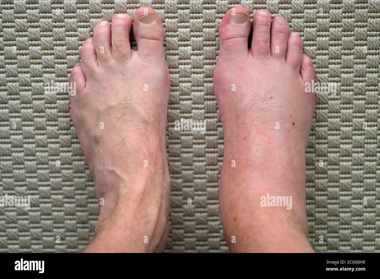 Homme avec un pied mal gonflé et enflammé d'une allergie réaction après une piqûre ou une morsure d'insecte en regardant vers le bas ses pieds d'en haut avec la guérison Banque D'Images