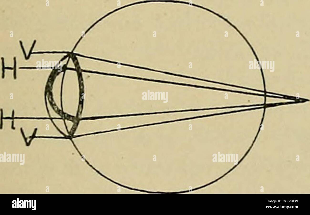 . La relation de la vue et de l'audition à la vie scolaire précoce . TED utilise le gome de jts pour la mise au point (hébergement) pour la vision à distance. Thisis anormal et dans l'économie de la nature aucune disposition adéquate n'a été faite pour les demandes qui sont ainsi lancées sur les muscles de l'accommo-dation. Normalement, ce pouvoir est tenu en réserve pour des fins de vision étroite.le logement a certaines limites très définies dans la portée ou le pouvoir et puisque l'oeil court utilise une partie de son logement pour la distance de voir, il a juste que beaucoup moins en réserve pour les fins de la lecture. Lire ou tout travail de proximité du Banque D'Images