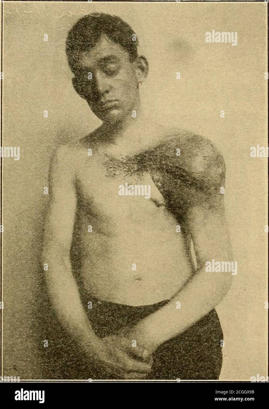 . Diagnostic physique . par leur position superficielle, habituellement externe aux muscles, et doux, sensation lobulée. Le sarcome forme la seule grande tumeur qui ressort de l'hu-merus. Il est généralement dur et bien sûr profondément assis (voir Fig. 22). Rupture de biceps. La moitié inférieure des biceps projette sharplylorsque le muscle est contracté, regardant comme si les biceps avaient glissé de son site normal. Cet aspect soudain après la tension ou la tension du biceps est diagnostique. Les nœuds syphiliques sont aplatis sur l'os, généralement de la taille d'un demi-dollar, et se sentent comme le callus après un f Banque D'Images