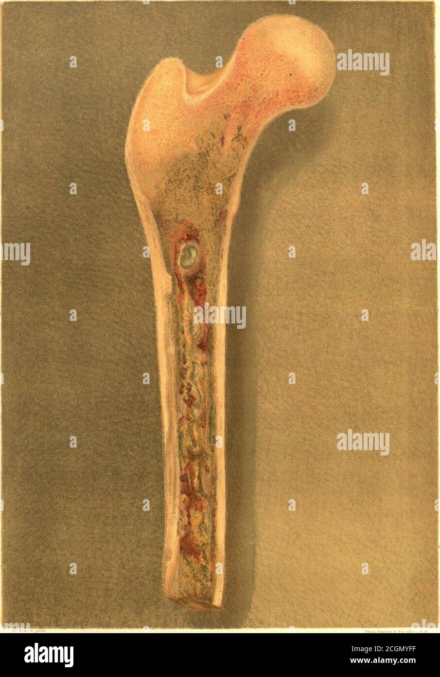 . L'histoire médicale et chirurgicale de la guerre de la rébellion. Partie III, volume II (3e volume chirurgical) . -.droite; volet. Chirurgien confit. Nous l'ont rassembé le 15 juillet. 1865.droite : rabat. A. Surg. R. Bartho- low.États-Unis Réd. Os cariant. Dischd avril 26.65. Spéc. 2105.droite : rabat. Surg. F. Seymour, 11. S. V. Dischd juin 18, 1863.droite; rabat. Dr C. Freiot, Troy, New York. Dischd janvier 4, 1865.Left: circ. 1865.droite. Dischd août 11, spéc. 417.gauche. (Gangrène.) Dr White. Dischd le 28 octobre 1862. Retraite en mars 30,1865. HOMANS (J, jr.). Cas de rupture par balle du Thigh, Résultats du su conservateur Banque D'Images