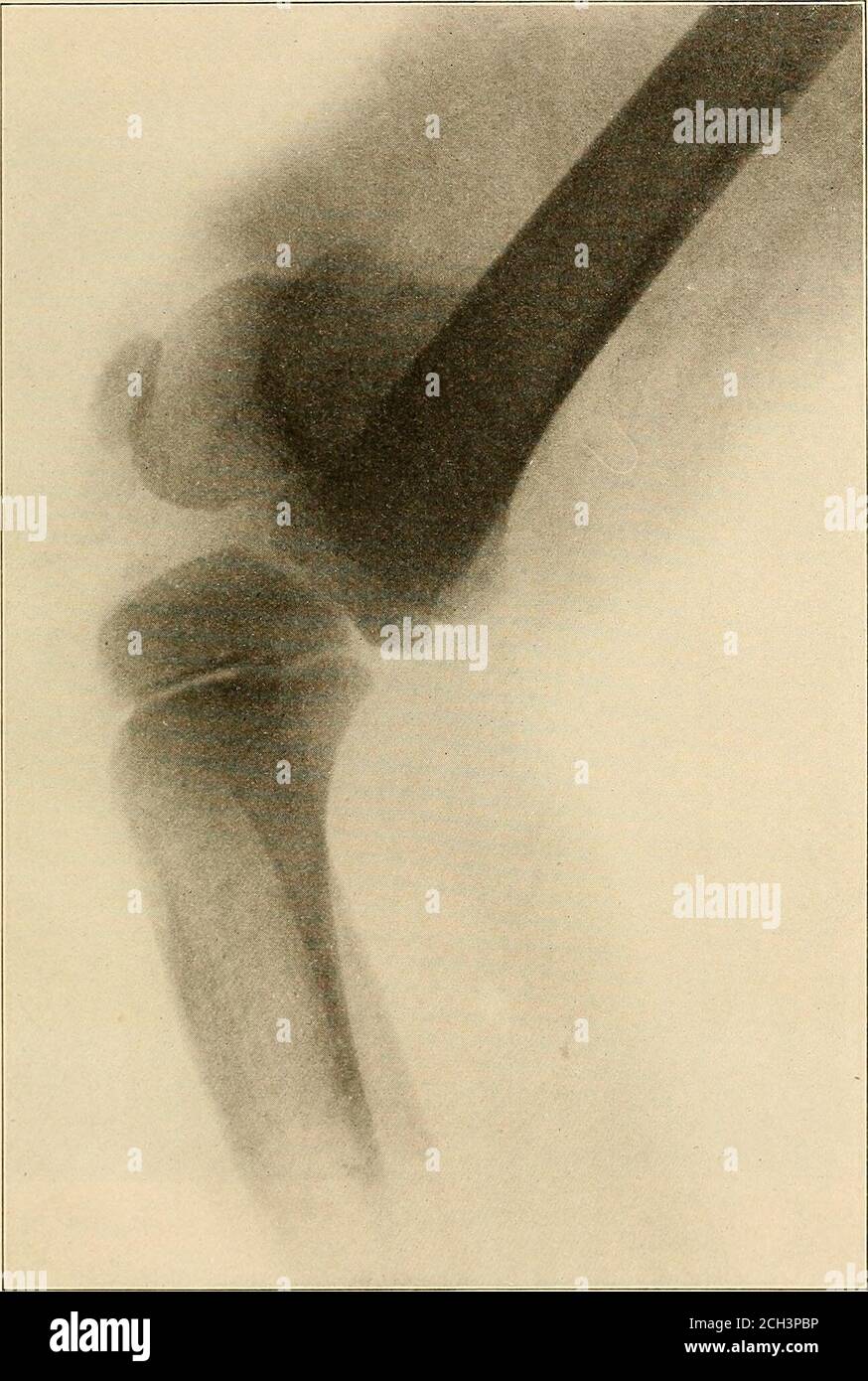 . Principes de l'électromédecine, de l'électrochirurgie et de la radiologie : un traité pratique pour les étudiants et les praticiens. Avec des chapitres sur la vibration mécanique et la technique de la pression sanguine . Plaque XVII Hallux valgus, droite et gauche. Avec l'aimable autorisation de McIntosh Battery and Optical Co. Electro-médecine, électrochirurgie et radiologie 201. Plaque XVIII dislocation epiphyse inférieure du fémur. Gracieuseté de McIntosh Battery and Optical Co. 202 Anthony Matijaca Banque D'Images