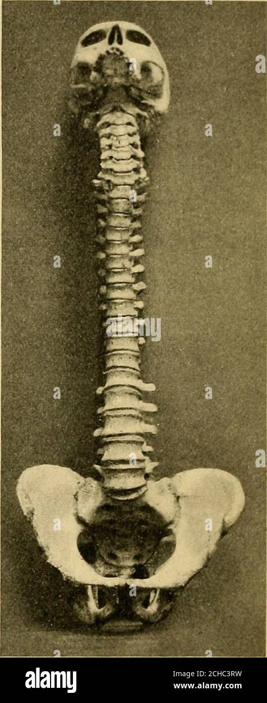 . Courbure latérale de la colonne vertébrale et épaules rondes . bocal de marche. La longueur totale de la colonne vertébrale est donnée comme suit par différents auteurs: Cunningham, 70 à 73 cm.; Morris, 70 cm.; et Krause, 72 à 75 cm. (Le long des courbes), qui est de 45 pour cent, de la longueur du corps. La longueur therélative des régions séparées est indiquée dans le tableau suivant : Cunningham.1 Morris.- Beaunois. Hommes de Dwight. Femmes. Région cervicale 13-140111. 12.5 cm. 10.8 cm. 13.3 cm. 12,1cm. Région dorsale 27-29 cm. 27.5 cm. 27 cm. 28.7 cm. 26.5 cm. Région lombaire 12-15 cm. 17.5 cm. 16.8 cm. 19.9 cm. 1S.7 cm. ^ Cunningham: Tex Banque D'Images