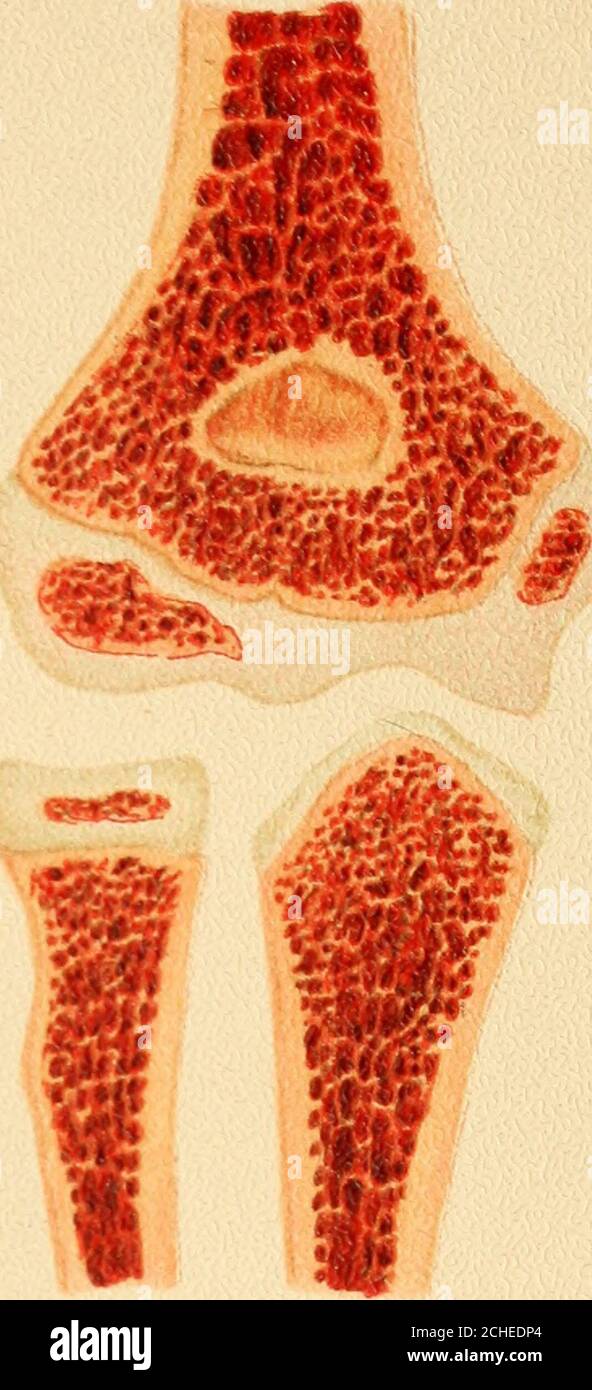 . Atlas et épitome de traumatiques . de la surface fracturée correspondant à la projection de l'asclair visible sur le fragment supérieur. La projection et la perte de substance ne sont pas en face l'une de l'autre; la rotation extérieure du fragment supérieur (supination) ayant entraîné le déplacement du projectionà travers près de 180 degrés. La leçon à tirer est que même en cas de fracture isolée du rayon, le bras doit se reposer en supination ou à mi-chemin entre supination et pronation. Figure 3.—les épiphyses des os qui entrent dans la formation du coude-joint, montrant divers centres d'ossification. Banque D'Images