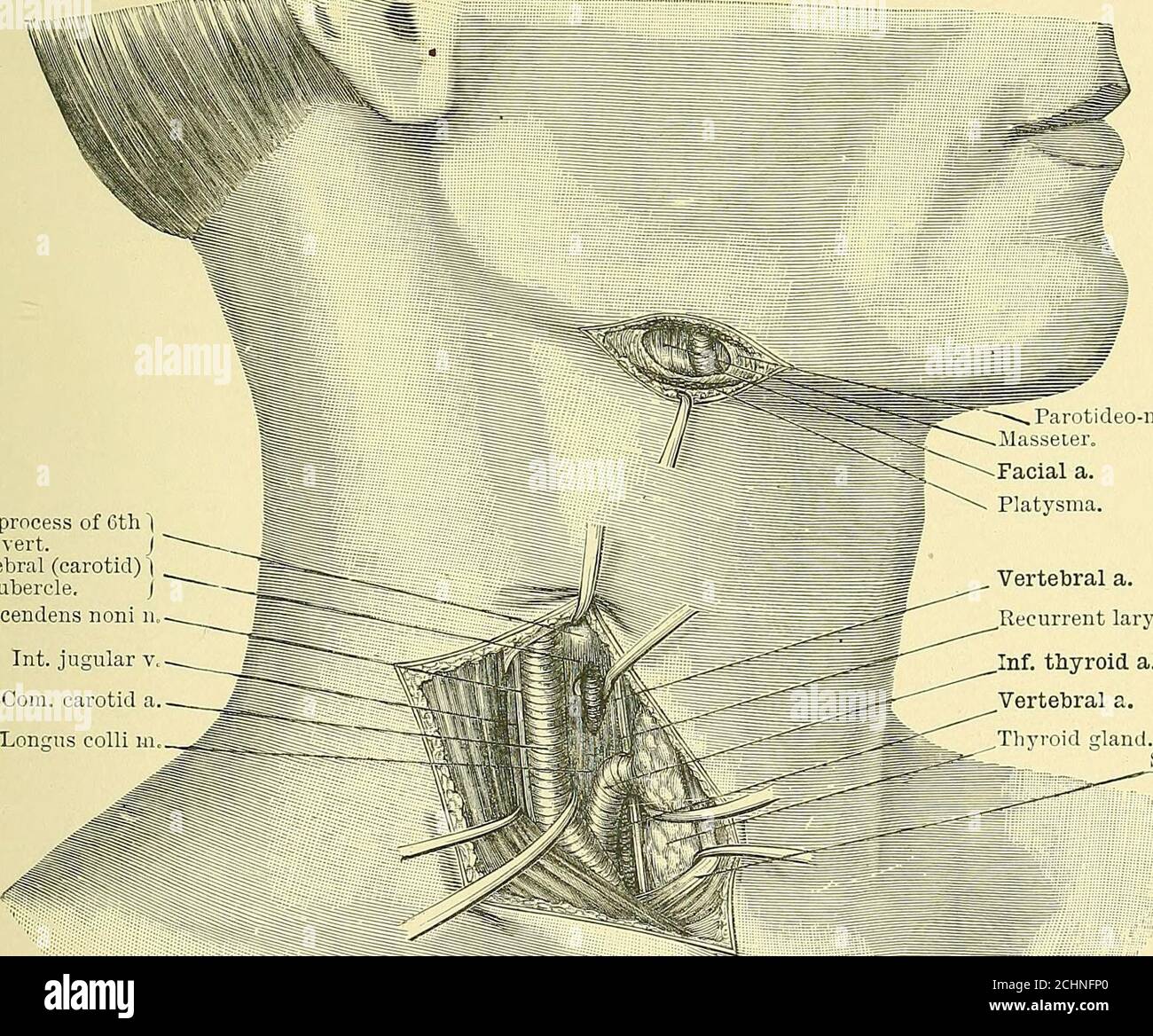 . Texte-livre de chirurgie opérative . iclature de l'artère linguale au-dessus de tlie plus grand cornu de l'hyoïde. Ligature de la carotide commune au niveau du cartilage cricoïde. Ligature de l'artère innominate. Ligature la première partie de l'artère axillaire. Ligature de l'artère mammaire interne. LA CHIRURGIE DU GRAND ARTE RIES cornu de l'os hyoïde par le biais de la skiii, de la platysma et du fascia, et la bordure inférieure de la glande sous-maxillaire est tirée vers le haut avec la veine faciale de tlie. L'artère liesin l'angle formé par la bordure supérieure du digastrique (avec le muscle stylo-hyoidmuscle) et t Banque D'Images