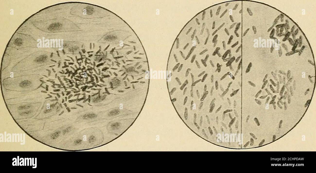 . Fièvre typhoïde; sa cause, sa transmission et sa prévention . Apparence ordinaire. Taché pour montrer la flagella... Croissance des bacilles dans la Splaeen. Apparition des bacilles dans le test Widal, avant et après le clampage. Figure 2. LA FIÈVRE TYPHOÏDE BACILLUS. Grossie autour des diamètres i,ooo. Et ainsi de suite. Sous le microscope, les cellules peuvent être otensees dans l'acte de division, — certaines avec une élongation. Fièvre typhoïde Lo. Certaines avec une légère constriction, et certaines cellules astwo apparaissant attachées; parfois des chaînes de cellules divisées peuvent être vues, regardant comme des liens de saucisses microscopiques, mais se déplaçant avec a s. Banque D'Images