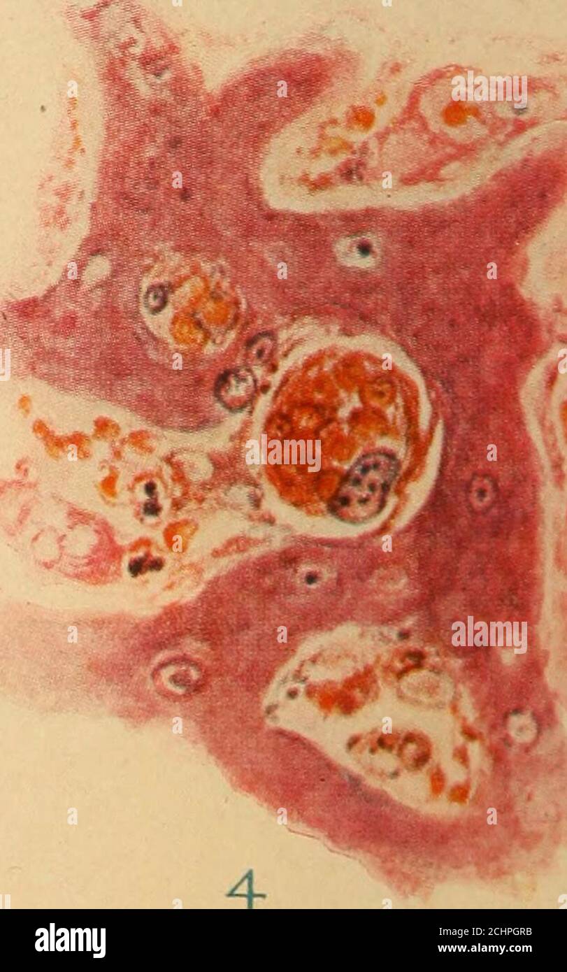 . La rate et anæmia; études expérimentales et cliniques . Ganglions lymphatiques et foie de chiens splénectomisés recevant du sérum hémolytique et des cellules showingphagocytiques contenant des globules rouges. Pagt 179 EXPLICATION DE LA PLAQUE I. les dessins ont été réalisés avec la caméra lucida et avec un Spencermicroscope, objectif, 4 mm., oculaire, 8. Fig. 1, 2 et 3 représentent des lésions chez un chien qui était splénectomizedon le 11 mars 1912, a reçu du sérum hémolytique le 14 mars et a été diedon le 15 mars. Le laps de temps réel était d'environ trente-six heures. Figure 1. Sinus périphérique d'un nœud lymphatique mésentérique contenant le grand nu Banque D'Images