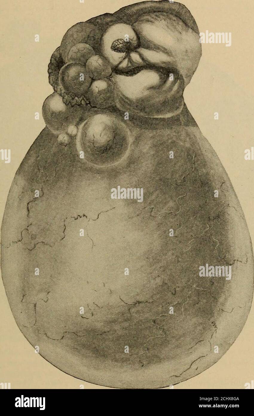 . Le diagnostic des maladies des femmes . les vaisseaux sanguins sont seento prendre un cours irrégulier; les veines sont plus grandes et plus numères que les artères. On observe souvent des projections villosités qui se développent à partir de la surface interne de la paroi du kyste. Les villosités varient en taille et extentand forment des excrescences verrues, parfois longues et minces, plumes de likea. Le cadre des papilles est du tissu conjonctif dans lequel les vaisseaux sanguins se font. Couvrant le stroma sont un ou plusieurs morelayers de l'épithélium columnaire, montrant de nombreuses fodings irréguliers et reduplications qui pourraient être confondus avec la prolifération maligne Banque D'Images