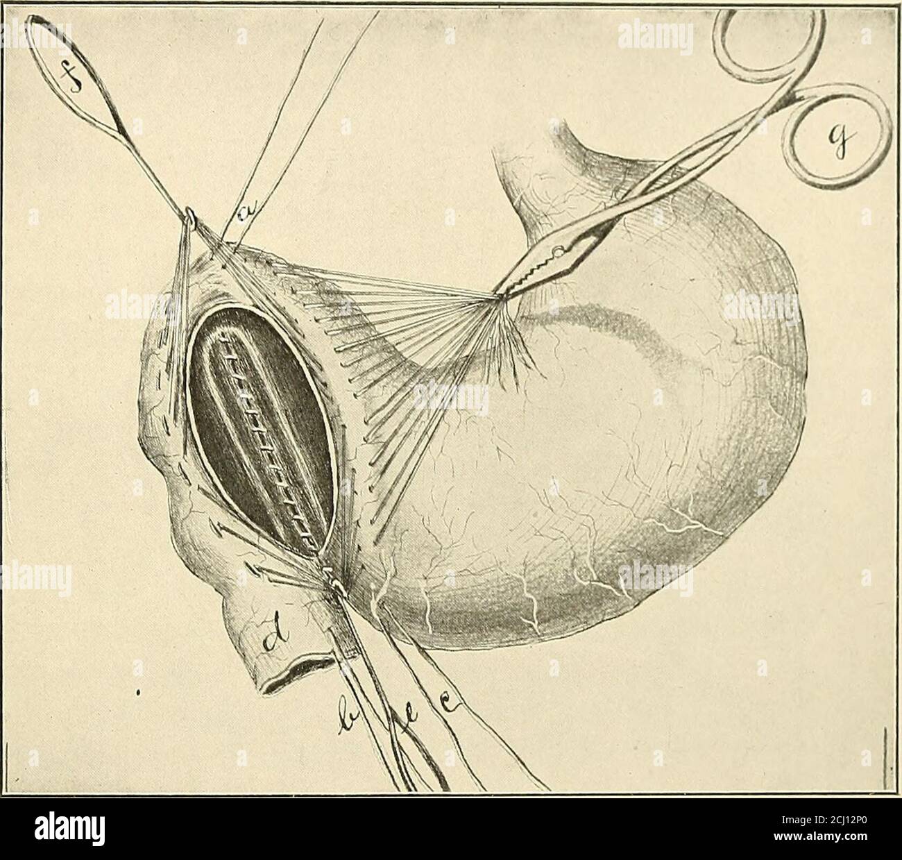 . La pratique américaine de la chirurgie ; un système complet de la science et de l'art de la chirurgie . Dans cette opération, la partie du duodénum en cause se trouve près du point d'entrée du conduit commun; Les observations sur le cadavre ont connu que, dans une proportion considérable de cas, le conduit de Santorini et le canal Wirsung entrent dans le duodénum à une distance considérable de l'entrée de CHIRURGICAL 1)ISI*]ASE DE L'ESTOMAC ET (OESOPHAGE. 377 tho oomnion (hict, et ils sont souvent si petits qu'il est difficile de le reconnaître durant cette opération. Ils pourraient facilement être blessés. Kuemmels Banque D'Images