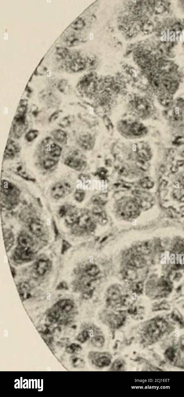 . Les organes endocriniens; une introduction à l'étude de la sécrétion interne . Il y a une petite quantité de tissu conjonctif réticulaire entre les cellules.QUELQUES nerfs ont été tracés dans les pars antérieurs de la pars nervosa. Dans certaines circonstances chez l'homme et les mammifères, en particulier dans les cas d'absence ou d'insuffisance thyroïdienne, un produit de sécrétion des 80 anteraux des cellules du lobe des organes Endocrines qui a l'apparence de colloïdes semble s'accumuler entre les cellules. Ceux-ci dans certaines parties viennent à être disposés autour de thecolloïde sous forme de vésicules qui ne sont pas très différents de ceux de thet Banque D'Images