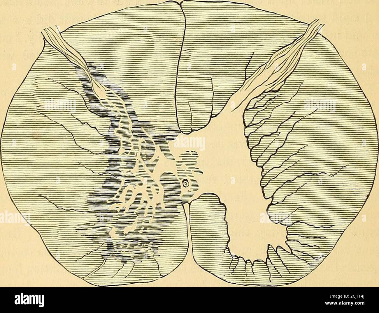 . Sur l'épilepsie : notes anatomo-pathologiques et cliniques (avec plaques et gravures originales). . régions d'alésage. 96 ANATOMIE PATHOLOGIQUE la médulla oblongue et la partie de la moelle épinière au niveau du deuxième nerf cervical, ainsi que des segments du cerveau et du cerebel-lum ont été sauvés pour examen microscopique. Aucune membrane n'encyte la lésion centrale dans le cervelet, avec une caractéristique microscopique du cholléstéatome, comme le montre la fig. 1, pi. ix.échelles ovales, et tables ngulaires de cholestéroléine, mélangées à de la matière amor-phique intertissées avec des fibrilles fines et des noyaux de compos de tissu conjonctivéreux Banque D'Images