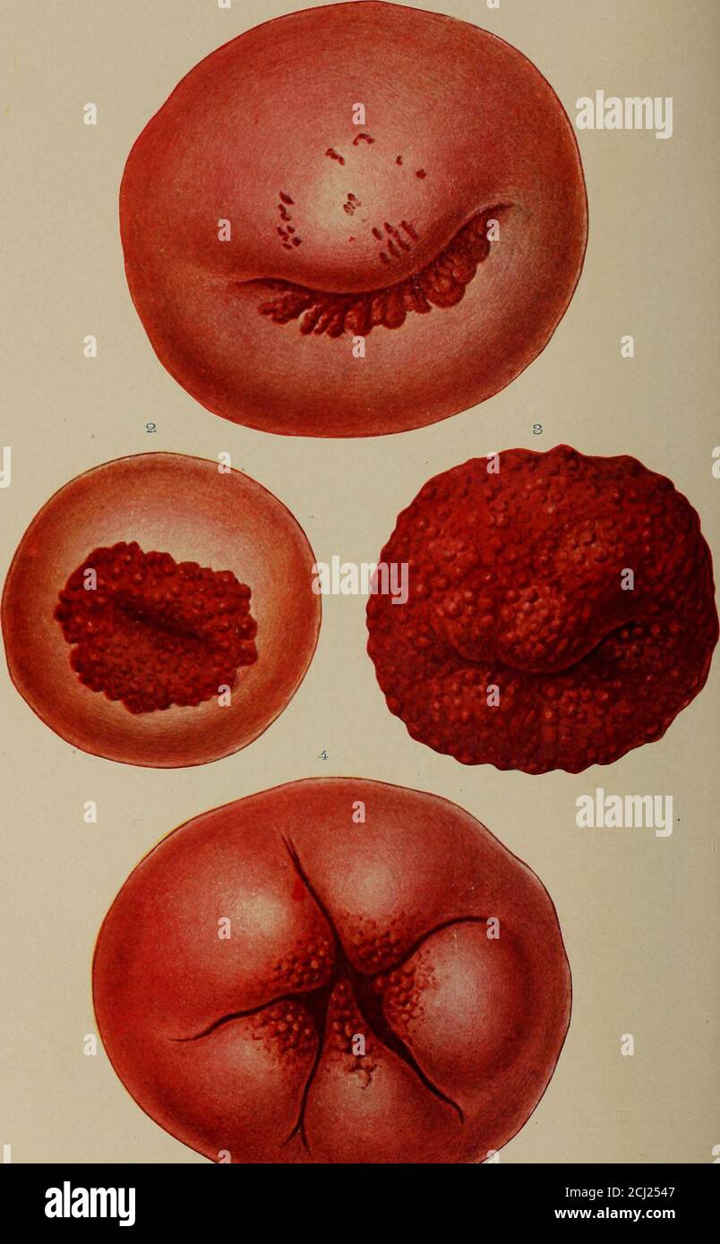 . Le diagnostic des maladies des femmes . Polype muqueuse du col de l'utérus, montrant la transformation de l'épithélium squameux intostratifié de l'épithélium columnaire. Cette condition peut être confondue avec une dégénation maligne. Mucus transparent ou peut être laiteux à partir de l'addition de leukocyteset de l'épithélium. Les polypes muqueuses d'origine inflammatoire dépassent de la mucosainto du canal cervical et sortent par l'os externe dans la thevagina (Fig. 128). L'examen microscopique des éraflures du col de l'utérus est unsatis-usine, pour la raison que l'épithélium de surface et les glandes sont fermement ancrées dans le TI conjonctif Banque D'Images