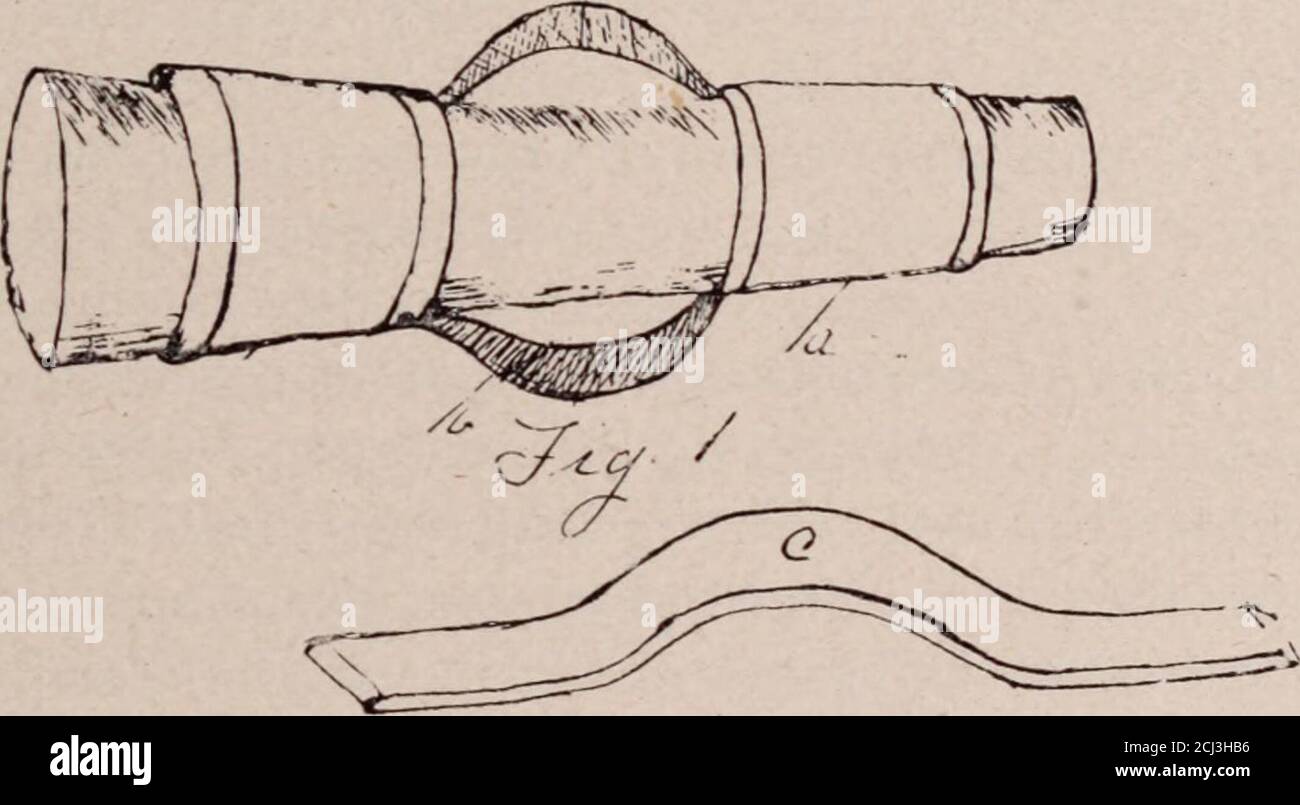 . Journal médical Interstate . an ne faites pas de mal. Pendant que le patient est sous anesthésie, la fracture est réduite et les fragments câblés ou thermoentraînés en position, et le pansement de rétention approprié appliqué en externe, la provision étant faite pour le soin de la plaie. Si la fracture est l'une des os du dessus ou de l'extrémité inférieure, comme c'est habituellement le cas, un soudogecast est le meilleur pansement. Il se compose de deux plâtres ordinaires, appliqués l'un au-dessus et l'autre au-dessous du point de fracture, et con-nected sur la fracture par deux sangles en fer, un de chaque côté de la limb, et travaillé dans la Banque D'Images