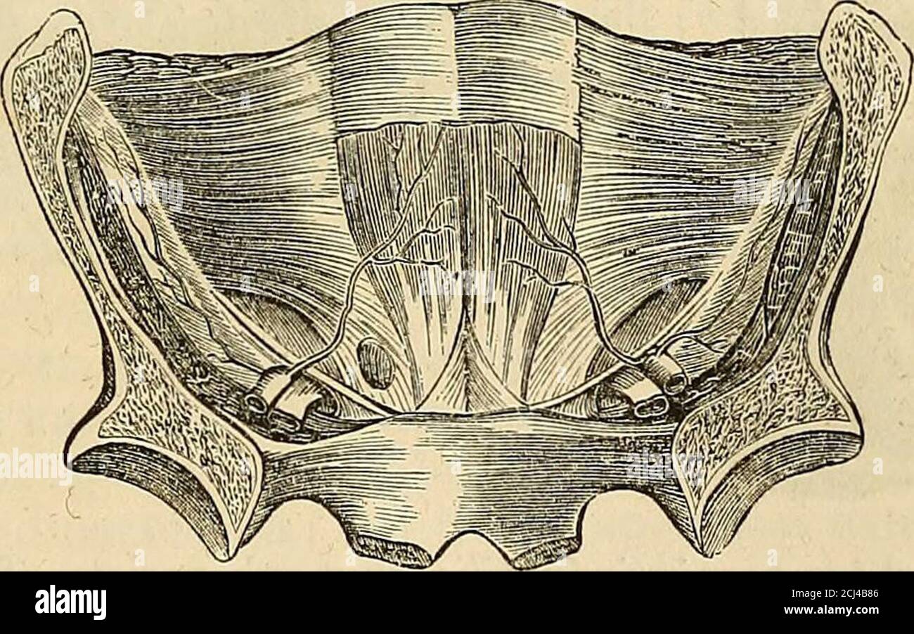 . Les principes et la pratique de la chirurgie moderne . gs. Il y a quatre variétés. L'oblique,—direct,—conge-nital,—et encysted. (1.) La hernie inguinale oblique est la plus fréquente. Il prend preciselyla même voie que le testicule prend dans son passage de l'abdomen intothe scrotum. Elle commence comme une plénitude ou un gonflement à la situation de l'anneau abdominal interne, c'est-à-dire un peu au-dessus du centre de Poupartsligament,—passe ensuite dans le canal inguinal (et à ce stade est calledbubonocele)—et si la saillie augmente, elle projette à travers l'anneau externe, et la desce Banque D'Images