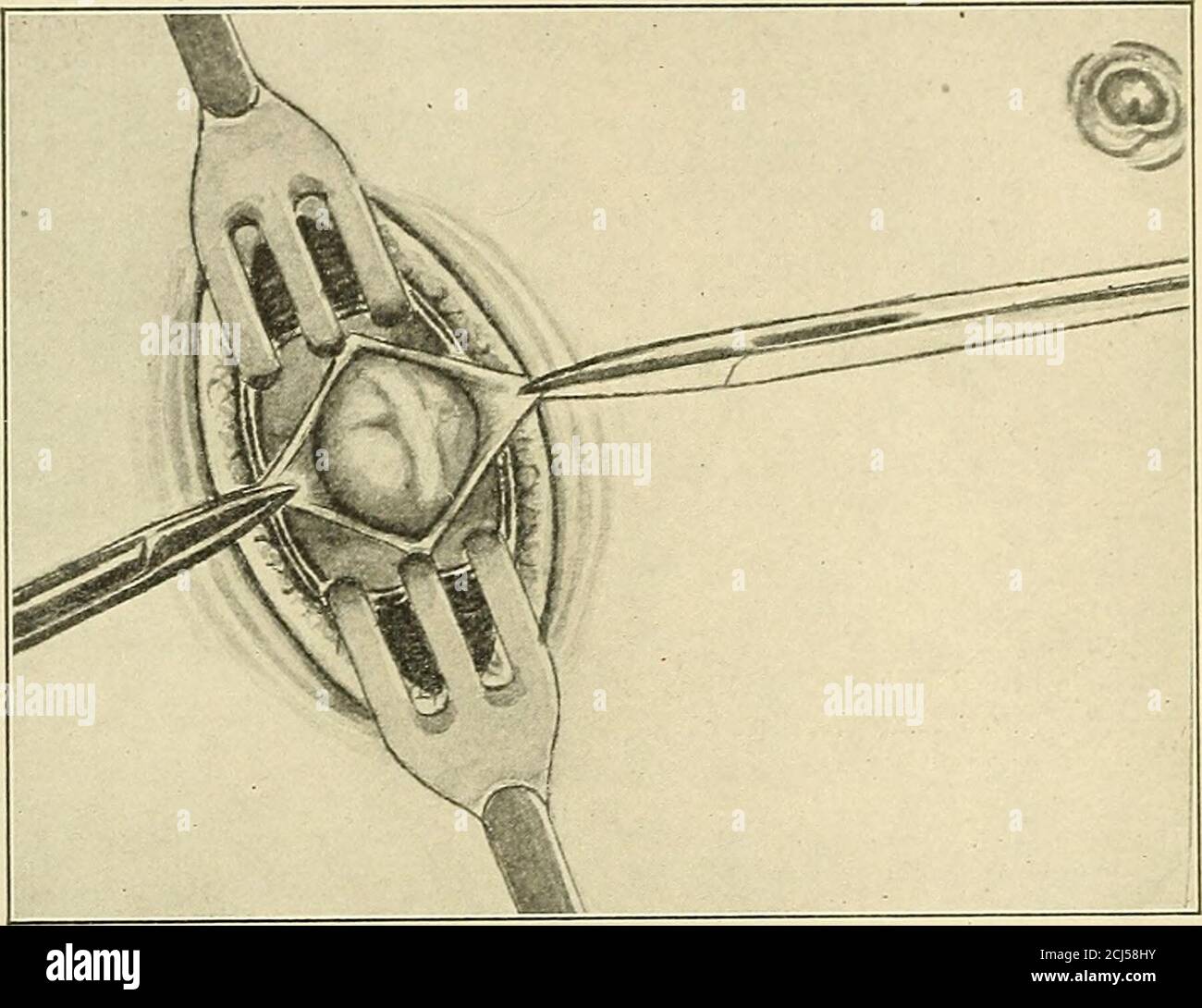 . La pratique américaine de la chirurgie ; un système complet de la science et de l'art de la chirurgie . Figure 55. — Inciontlirmante verticale intramusculaire le muscle droit Rectus au-dessus de l'Umbilicus. Les fibres du muscle sont classées sepa et maintenues séparément par des enrouleurs. 126 LA PRATIQUE AMÉRICAINE DE LA CHIRURGIE. Les canaux biliaires, les reins et la rate; l'incision ventrale oblique est utilisée pour explorer le csecuni et le sigmoïde, et pour ligaturer l'artère iliaque commune: La coupe oljlicinale peut être faite au-dessus ou en dessous du ligament de Pouparts, et est employée en herniotaments, dans les opérations sur la corde, ligotomes ronds, etc.; l'obliquité Banque D'Images . La pratique américaine de la chirurgie ; un système complet de la science et de l'art de la chirurgie . Figure 55. — Inciontlirmante verticale intramusculaire le muscle droit Rectus au-dessus de l'Umbilicus. Les fibres du muscle sont classées sepa et maintenues séparément par des enrouleurs. 126 LA PRATIQUE AMÉRICAINE DE LA CHIRURGIE. Les canaux biliaires, les reins et la rate; l'incision ventrale oblique est utilisée pour explorer le csecuni et le sigmoïde, et pour ligaturer l'artère iliaque commune: La coupe oljlicinale peut être faite au-dessus ou en dessous du ligament de Pouparts, et est employée en herniotaments, dans les opérations sur la corde, ligotomes ronds, etc.; l'obliquité Banque D'Images