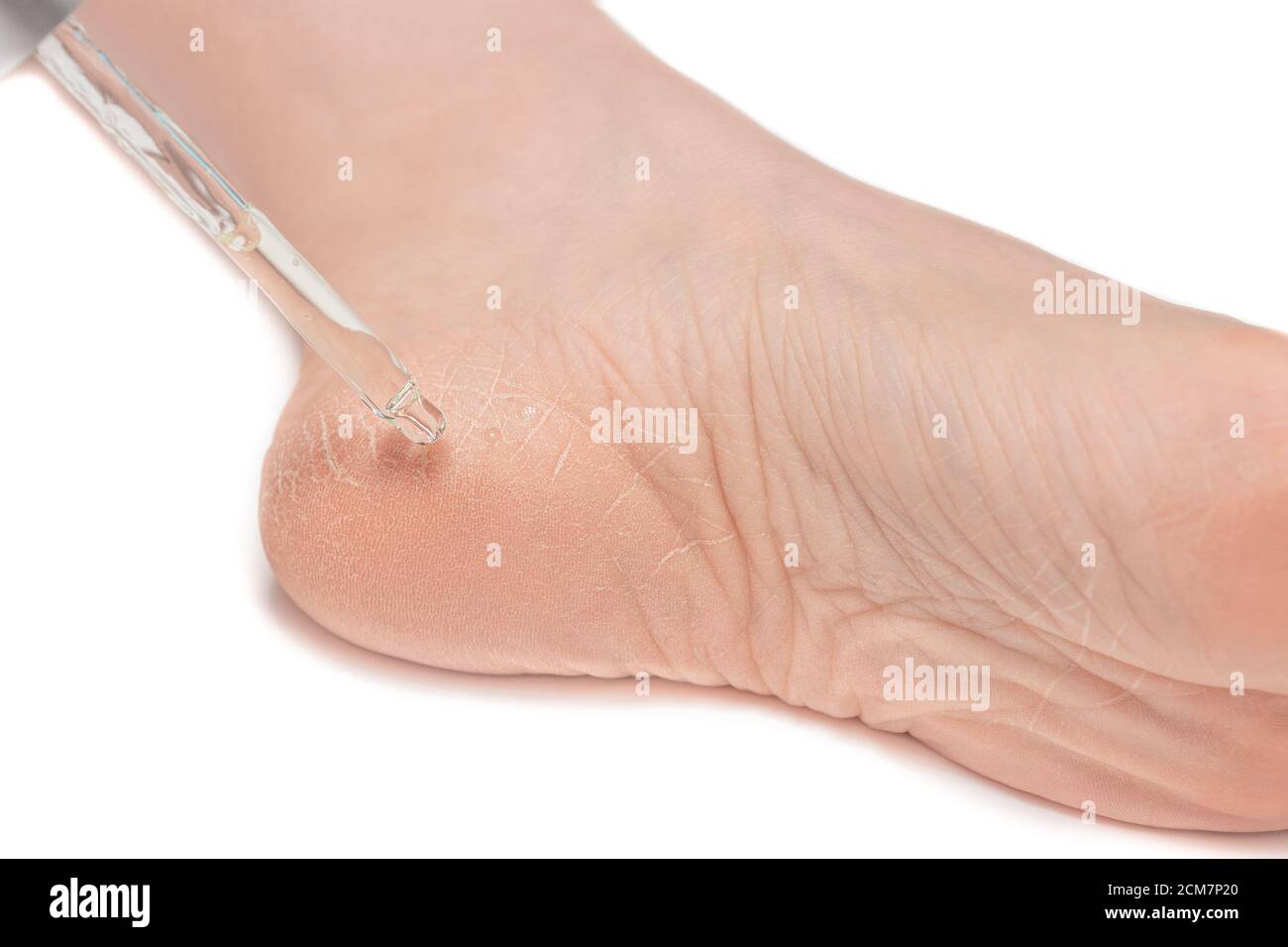 Gros plan du pied femelle, du talon avec une peau sèche et très fissurée et des fissures. Dermatologie, médecine, concept cosmétique pieds humains Banque D'Images