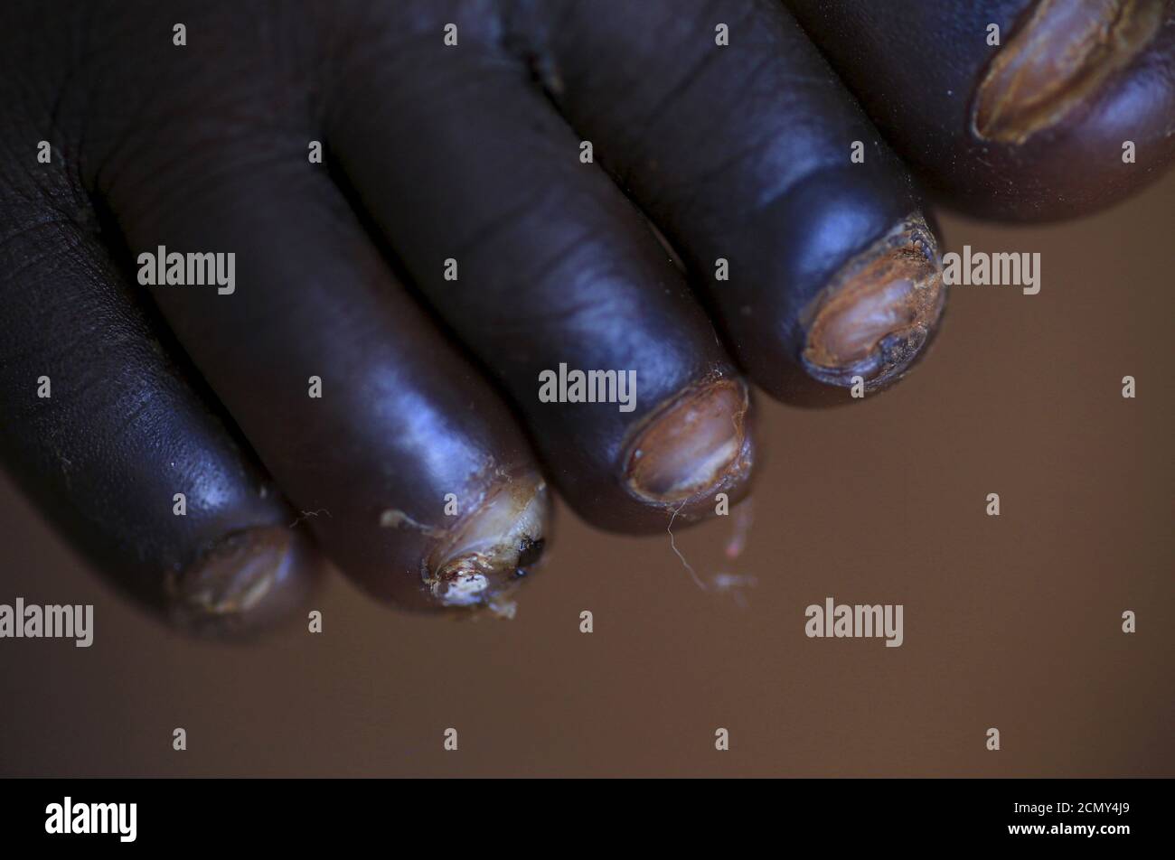 Les Orteils D Un Bebe Qui Hebergent Des Jiggers Sous Les Ongles Sont Vus Avant De Subir L Enlevement Et Le Traitement De Jigger Par L Organisation Sole Hope Dans Le Village De Kalebera District Les Orteils D Un Bebe Qui Hebergent Des Jiggers Sous Les Ongles Sont Vus Avant De Subir L Enlevement Et Le Traitement De Jigger Par L Organisation Sole Hope Dans Le Village De Kalebera District