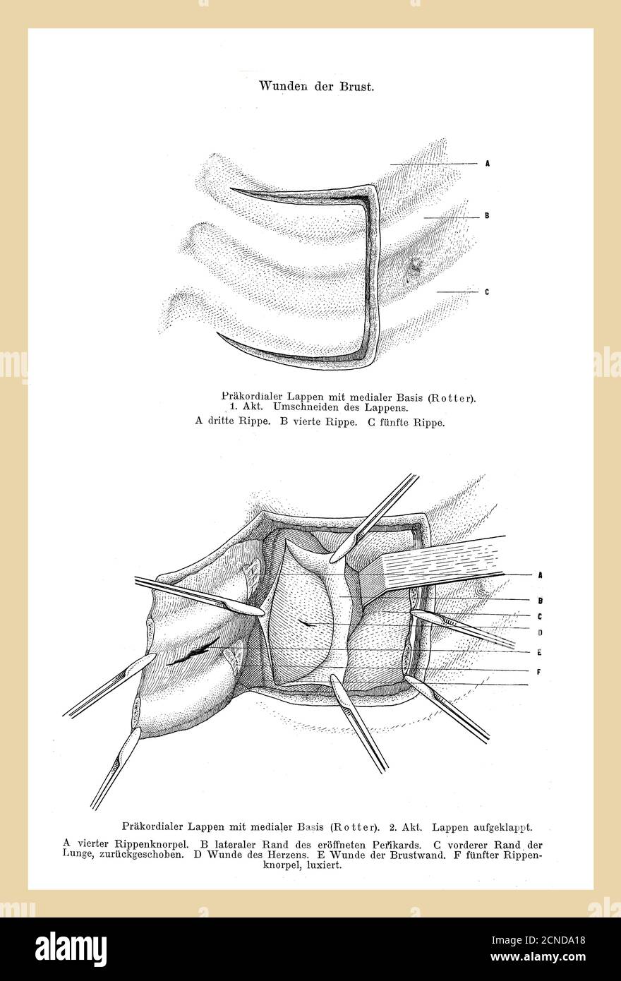 Santé, médecine et chirurgie: Coupe de lobe précordial, exposant les cartilages de côtes avec péricarde ouvert et bordure de poumon, illustration ancienne avec des descriptions allemandes Banque D'Images